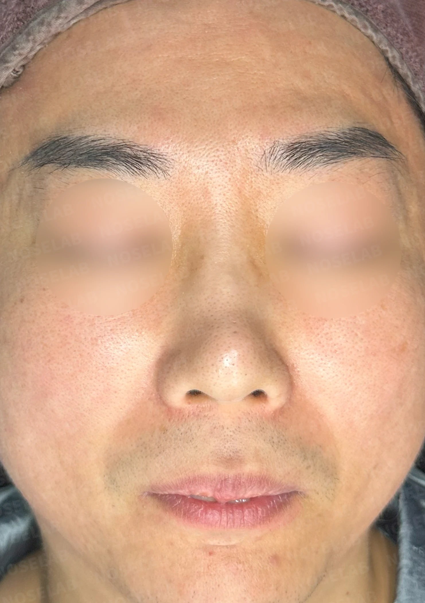 매부리코 수술 후 비대칭의 재수술 방법 — 수술 전 / 수술 직후 0일 직후 사진은 부기가 있는 상태로 최종 결과와 다를 수 있습니다.