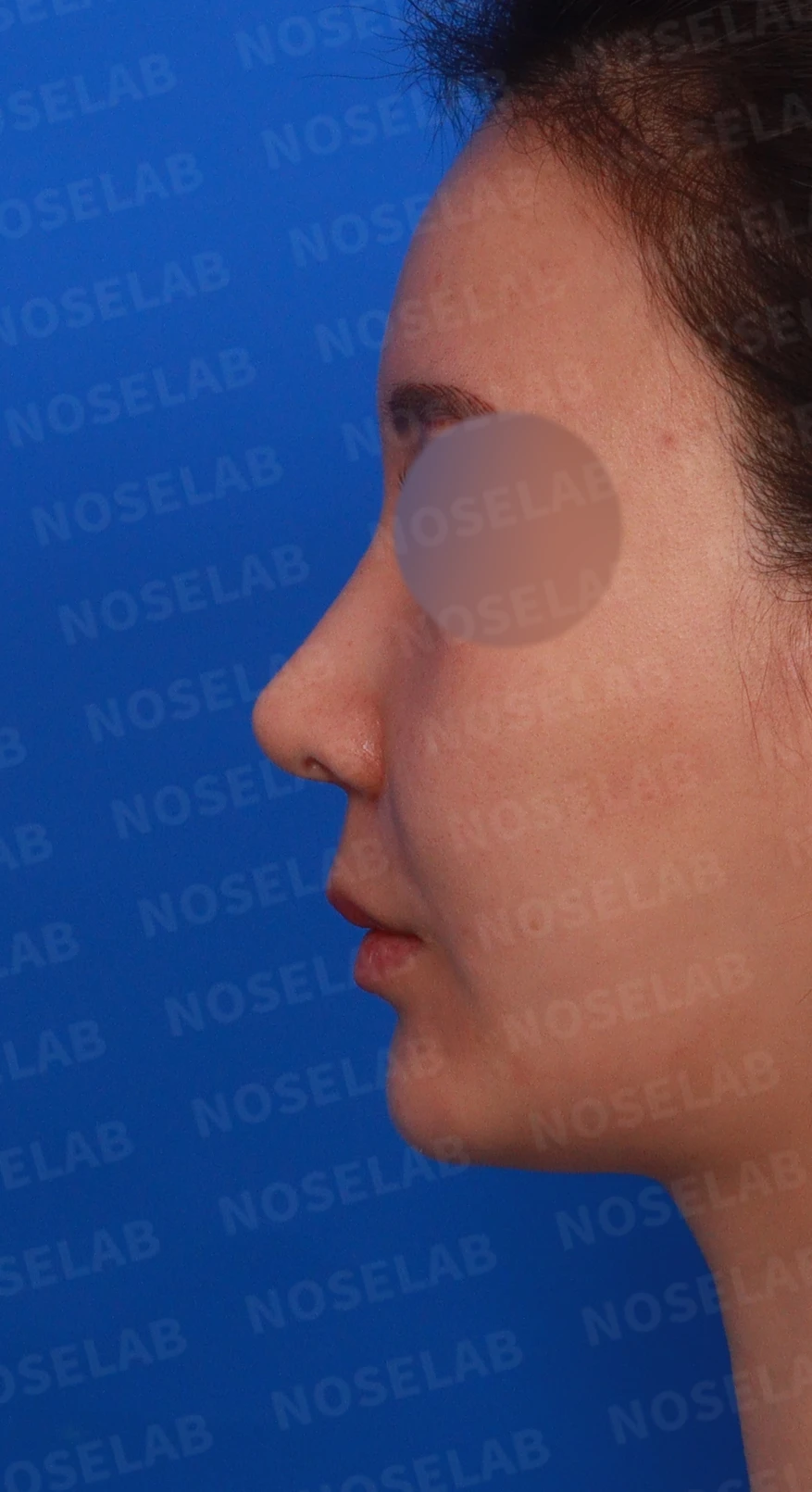 코가 휘어 보이고 비주가 한쪽으로 기우는 이유, 교정은 어떻게 하나 — 디자인 상담 정면, 좌측 측면, 비스듬한 측면 사진