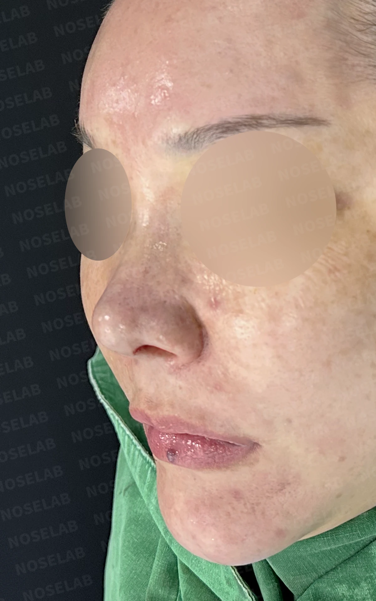 뭉툭하고 길게 처진 코가 중안면부를 길어 보이게 하는 이유, 석회화된 늑연골 재건 방법 — 수술 전 / 수술 직후 0일 직후 사진은 부기가 있는 상태로 최종 결과와 다를 수 있습니다.