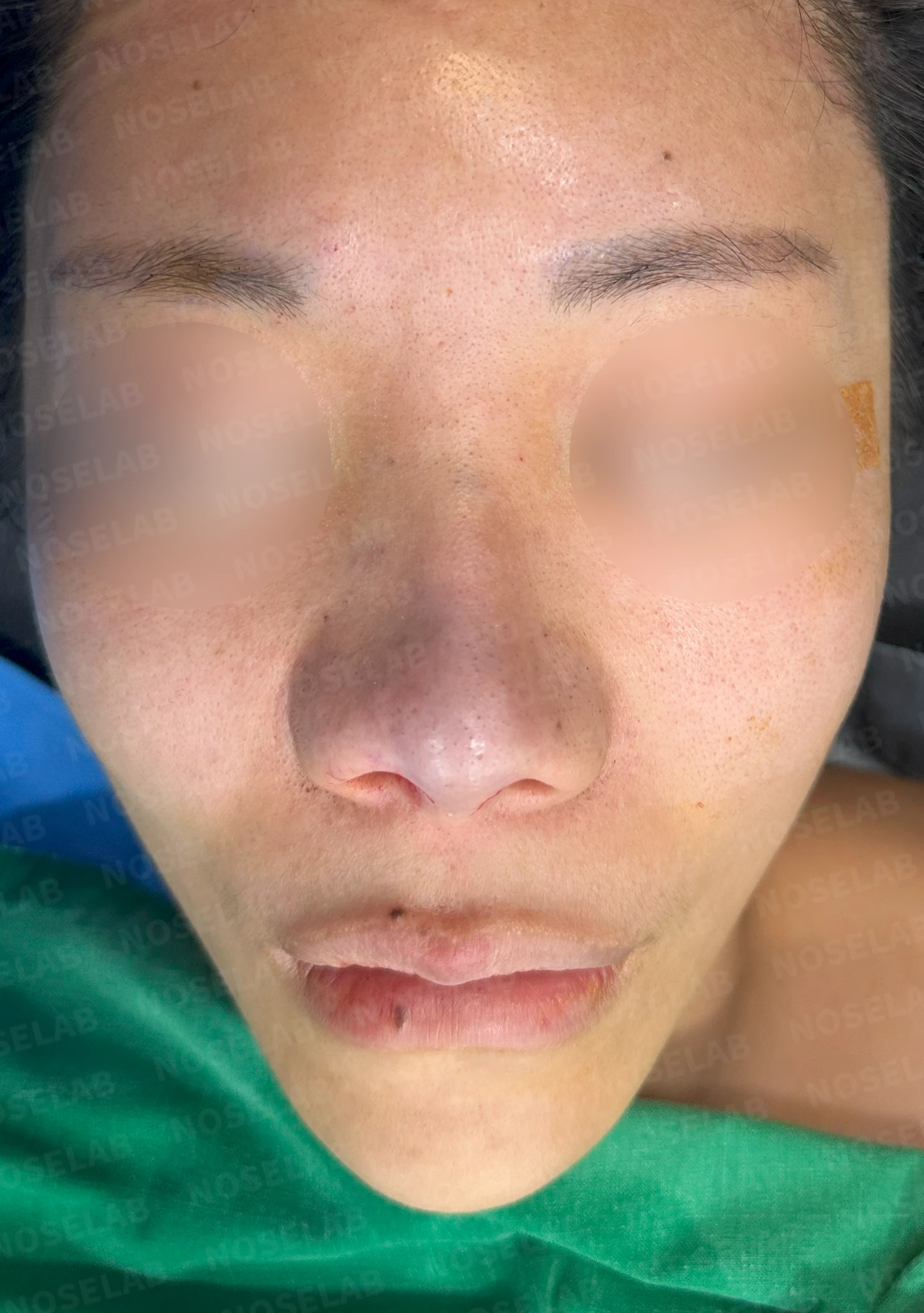 코성형 뒤 감염이 반복되는 이유, 염증 치료와 단계적 재건은 어떻게 하나 — 수술 전 / 수술 직후 0일 직후 사진은 부기가 있는 상태로 최종 결과와 다를 수 있습니다.