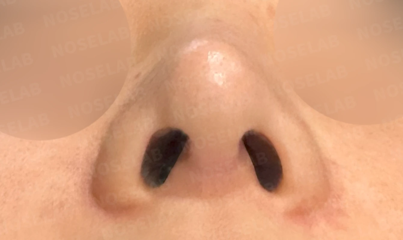 코가 휘어 보이고 비주가 한쪽으로 기우는 이유, 교정은 어떻게 하나 — 수술 전 / 수술 직후 0일 직후 사진은 부기가 있는 상태로 최종 결과와 다를 수 있습니다.