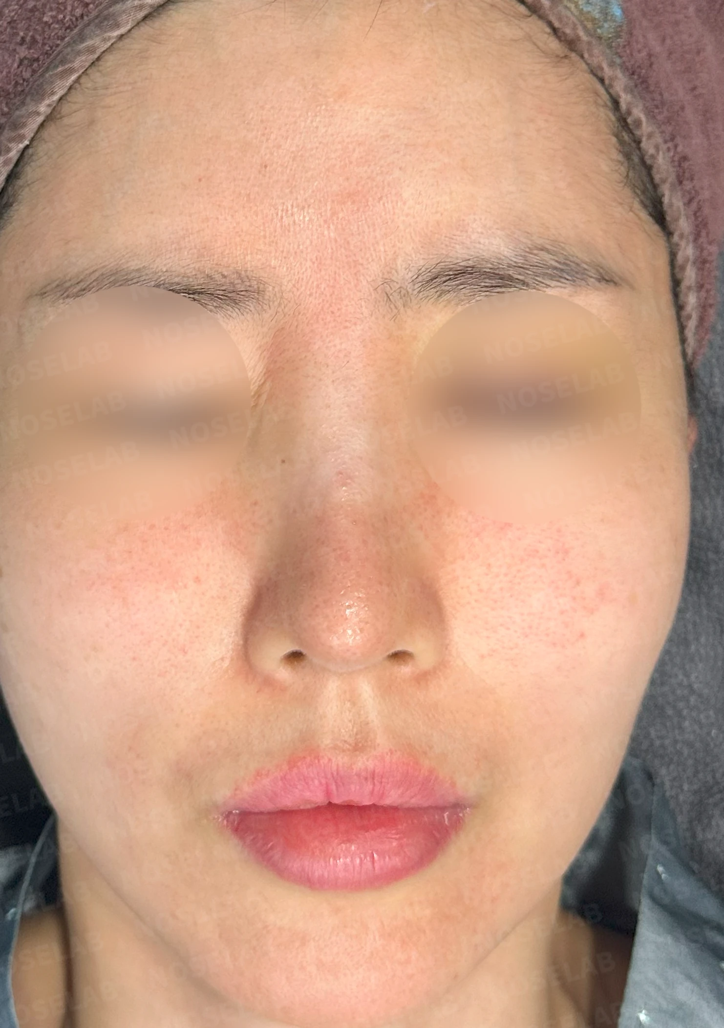 긴 코와 비대칭을 함께 교정하는 재수술 방법 — 수술 전 / 수술 직후 0일 직후 사진은 부기가 있는 상태로 최종 결과와 다를 수 있습니다.