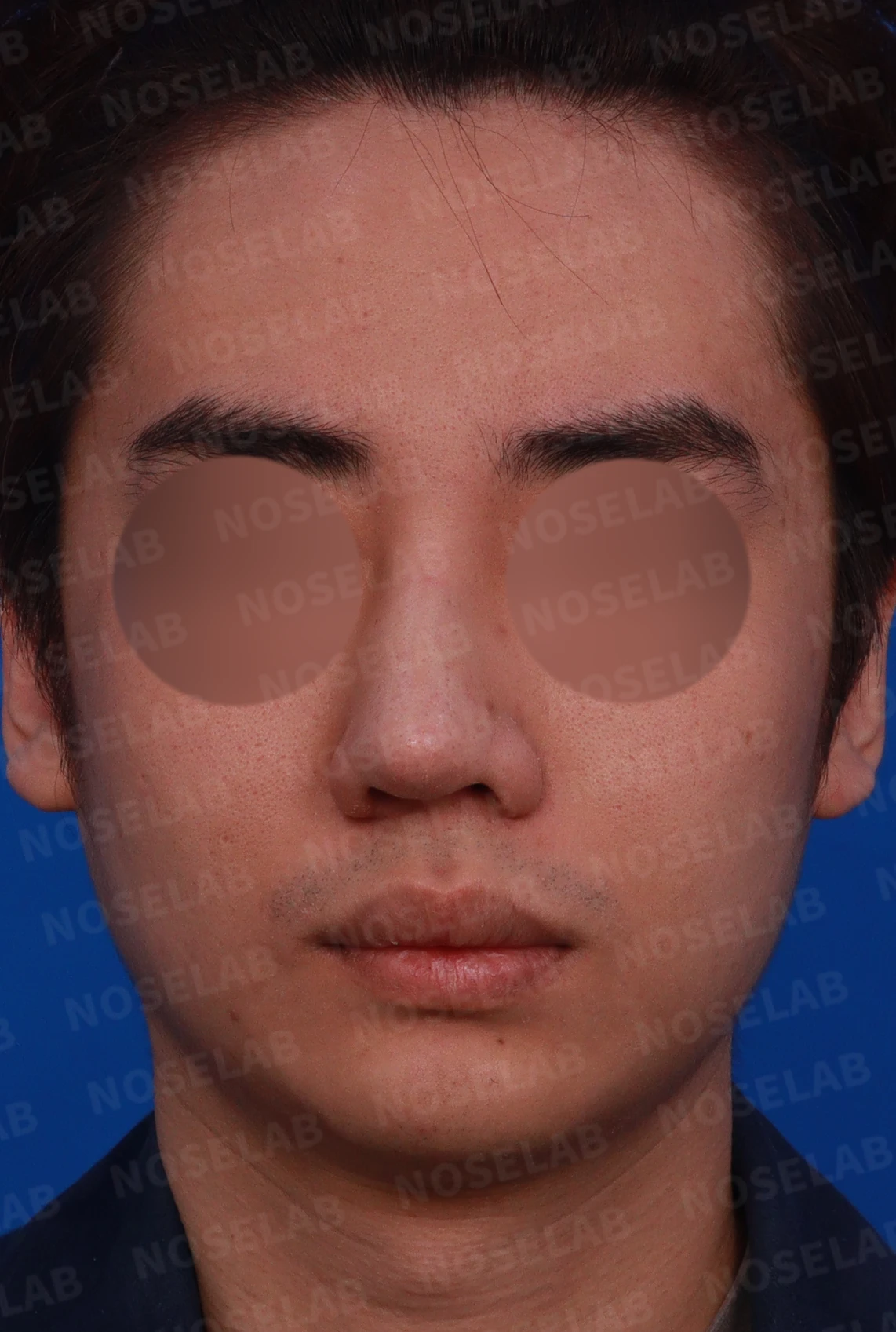코뼈 골절에 미용 수술을 함께 할 수 있는 경우와 단계로 나누는 방법 — 디자인 상담 정면, 좌측 측면, 비스듬한 측면 사진