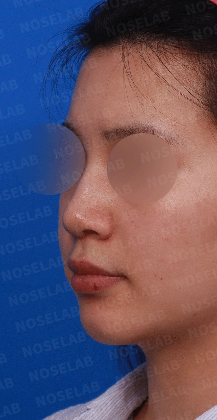 복코가 잘 교정되지 않는 이유와 이물질 제거 후 재건 방법 — 디자인 상담 정면 , 좌측 측면 ,비스듬한 측면 사진