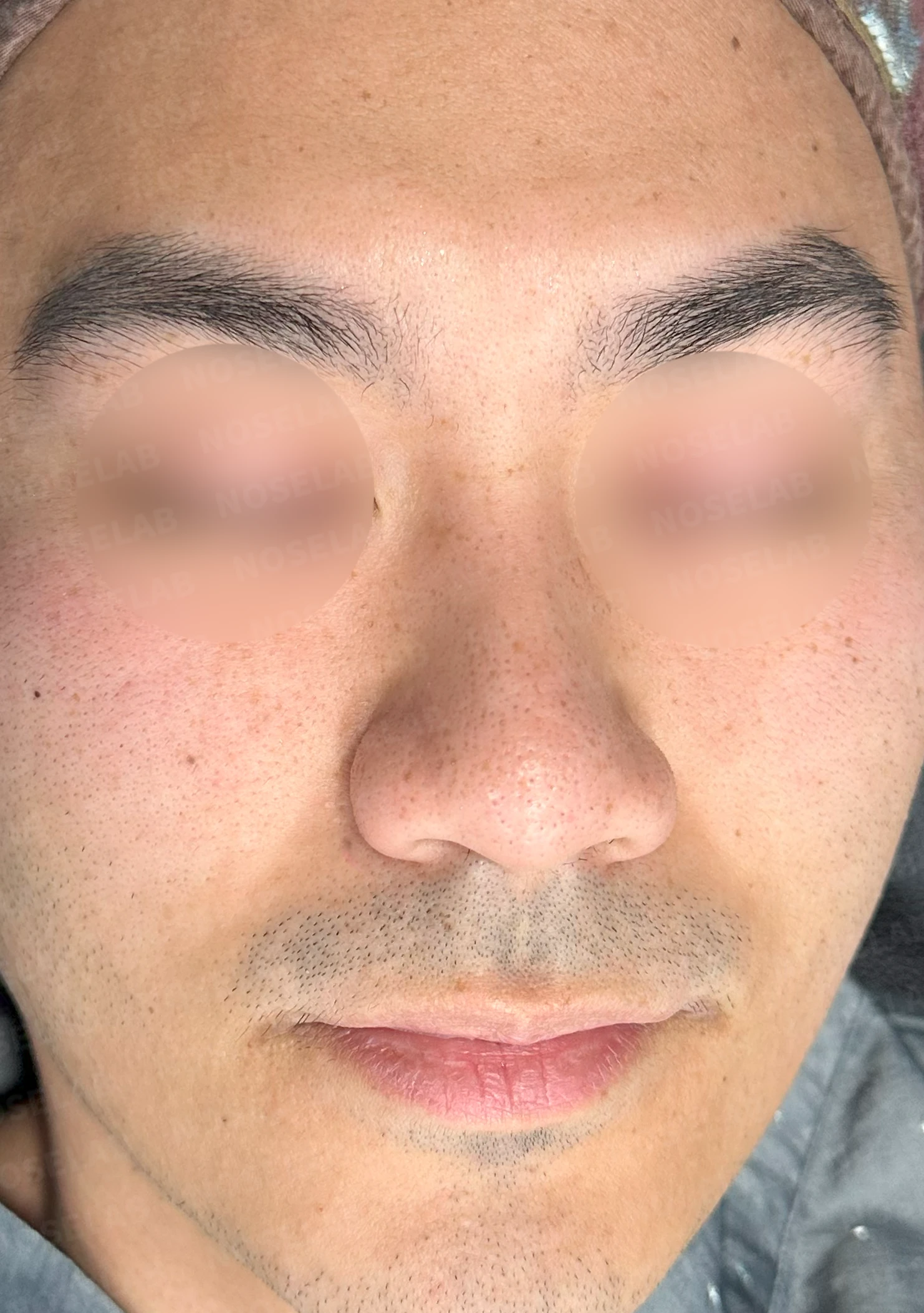 복코에 비공 비대칭과 코막힘이 함께 오는 이유, 직반 라인 교정은 어떻게 하나 — 수술 전 / 수술 직후 0일 직후 사진은 부기가 있는 상태로 최종 결과와 다를 수 있습니다.