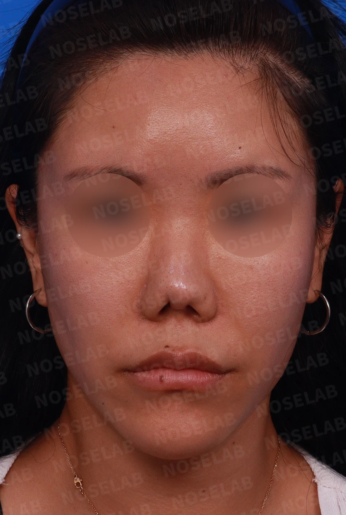 코성형 뒤 감염이 반복되는 이유, 염증 치료와 단계적 재건은 어떻게 하나 — 디자인 상담 정면 , 좌측 비스듬한 측면 , 측면 사진입니다.