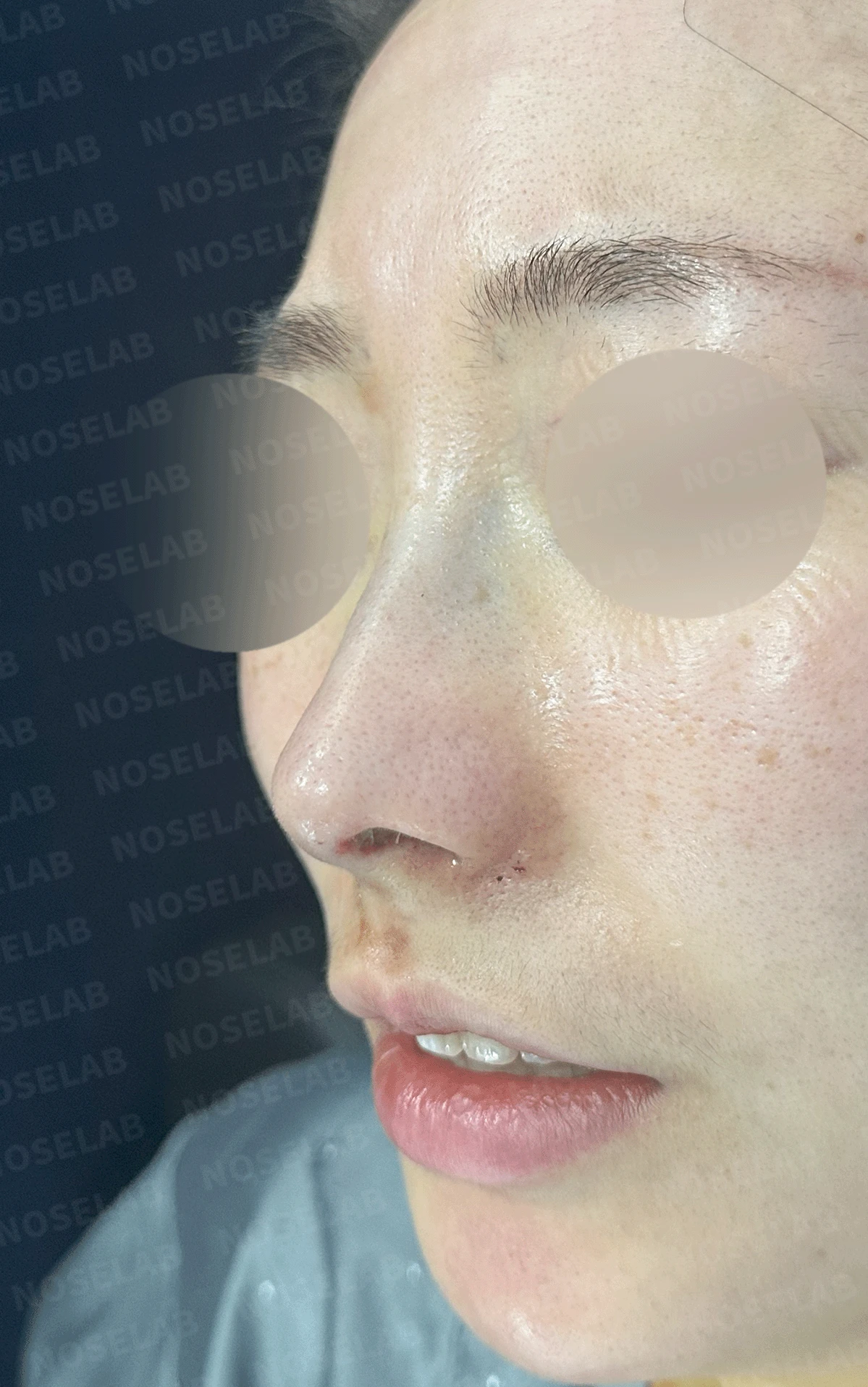 매부리코와 휜 코에 코막힘이 함께 오는 이유, 복합 교정은 어떻게 하나 — 본문 사진 12