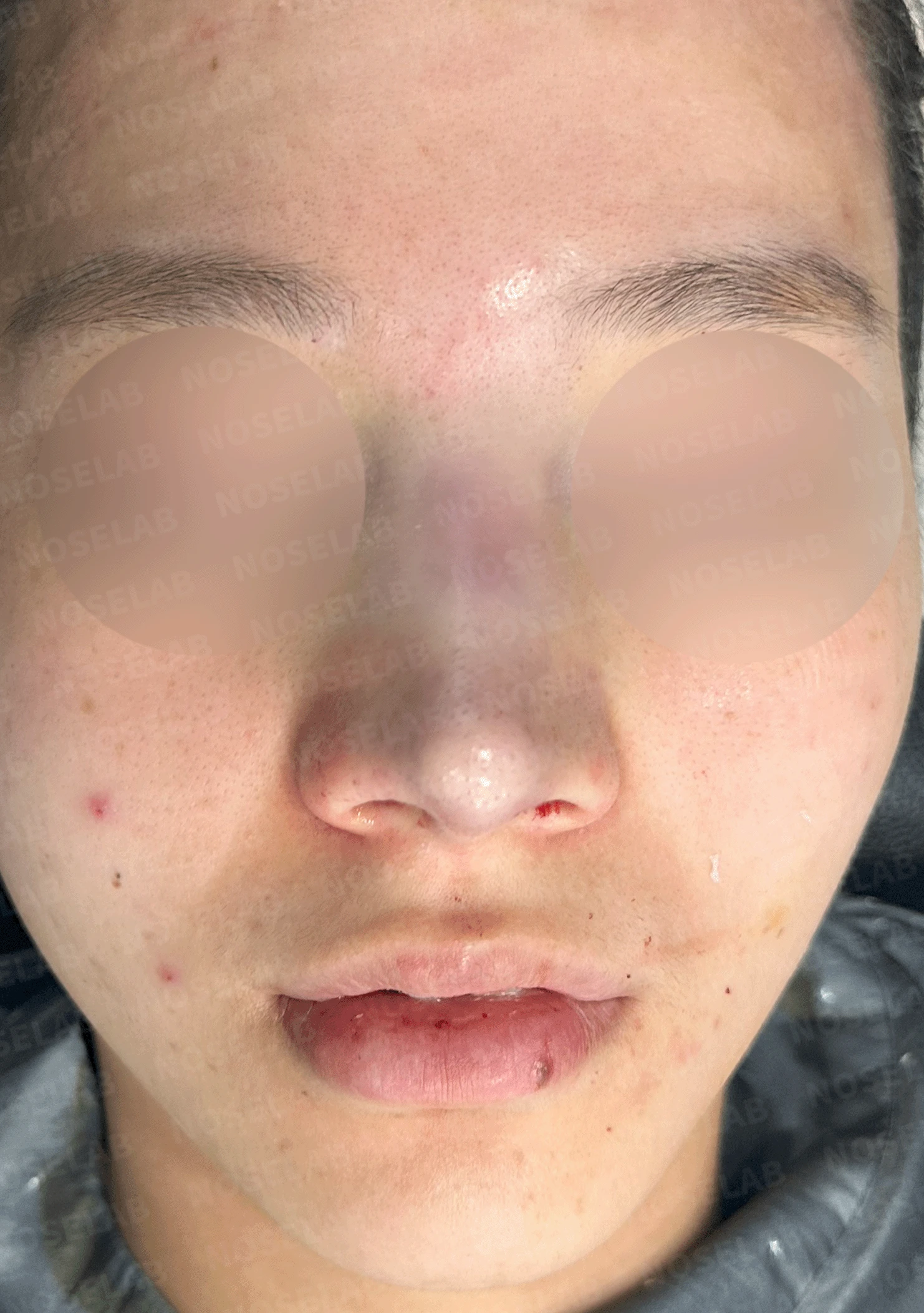 복코가 잘 교정되지 않는 이유와 이물질 제거 후 재건 방법 — 수술 직후 0일 정면 , 측면 , 비스듬한 측면 사진 직후 사진은 부기가 있는 상태로 최종 결과와 다를 수 있습니다.