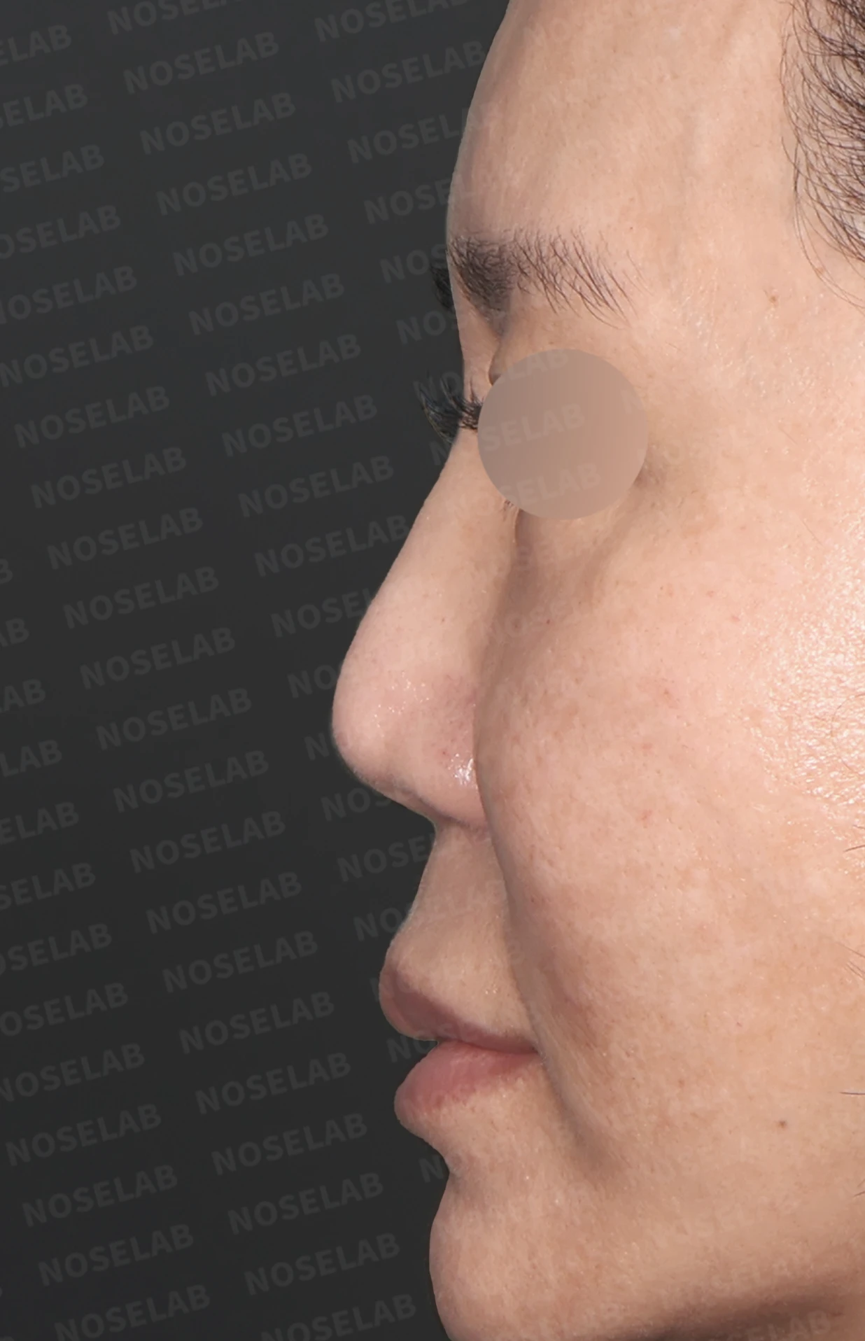 실리콘 재수술, 자가늑연골로 안전하게 코 라인 교정한 사례 — 전(좌) 직후(후)