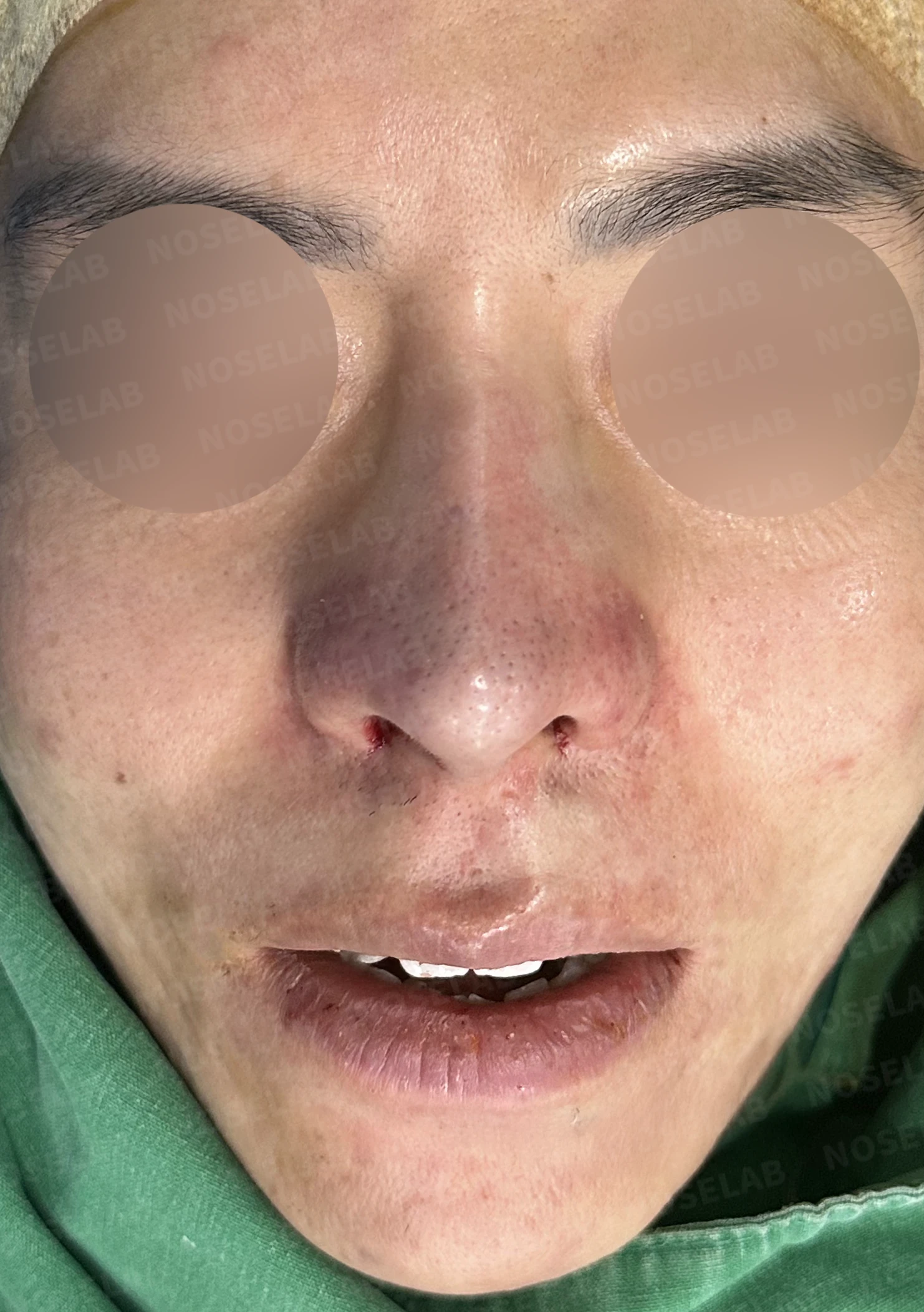 코재수술과 코막힘 교정, 기능과 심미 모두 잡은 비개방 코성형 사례 — 직후 정면, 비스듬한 측면, 측면 사진입니다.