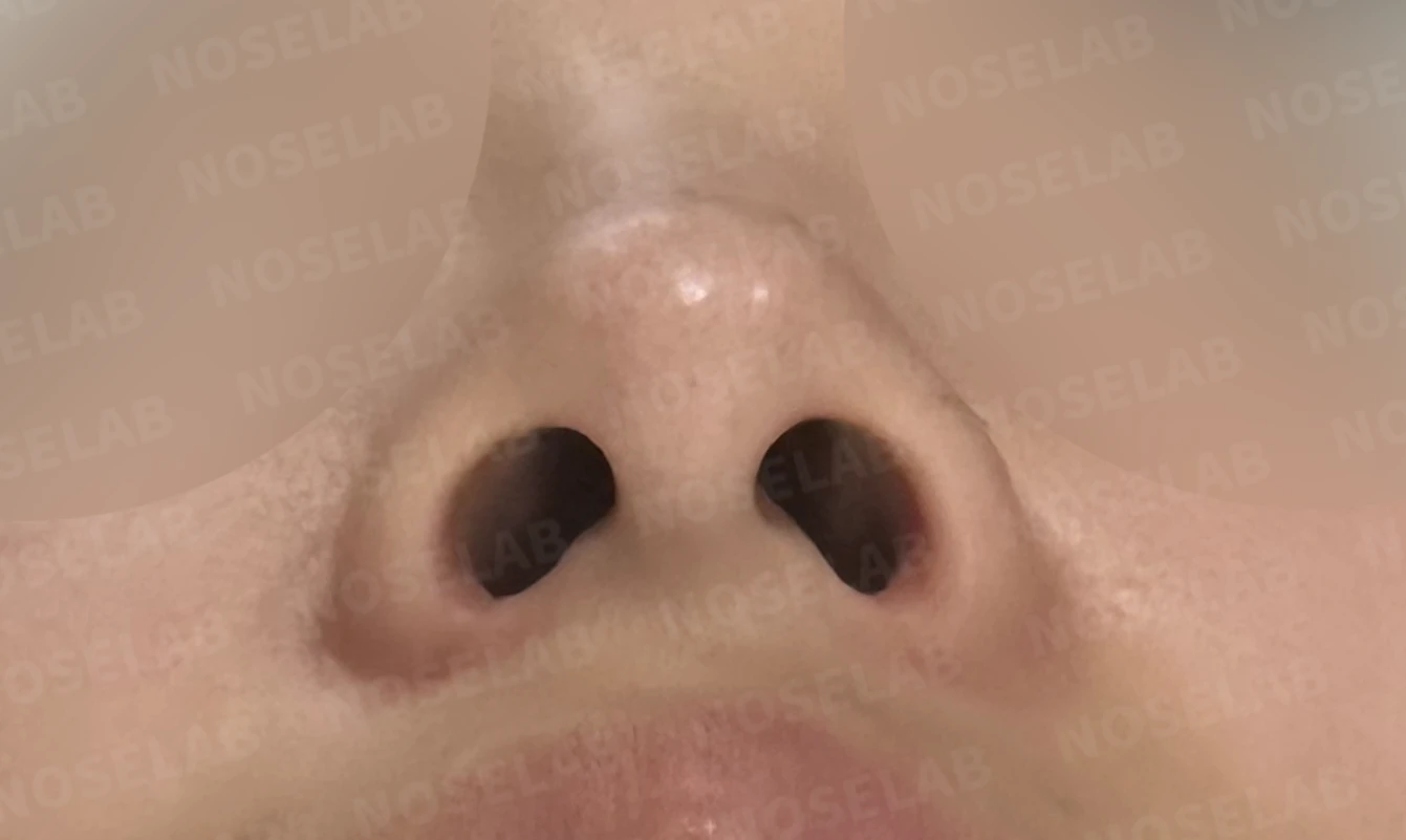 콧대가 넓고 단차져 보이는 이유, 절골술과 늑연골 코끝 성형은 어떻게 하나 — 수술 전 / 수술 직후 0일 직후 사진은 부기가 있는 상태로 최종 결과와 다를 수 있습니다.