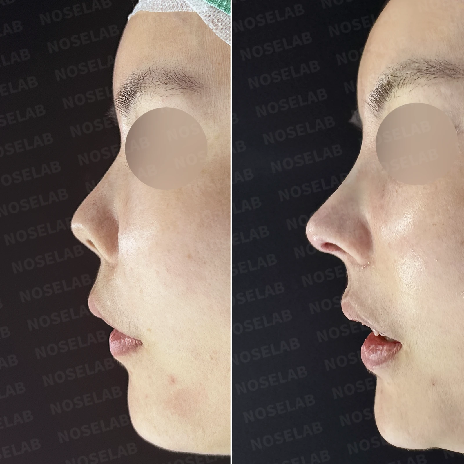 L자 실리콘 보형물이 비주 점막을 뚫기 직전까지 가는 이유, 제거와 자가늑연골 재건 방법 — 본문 사진 20