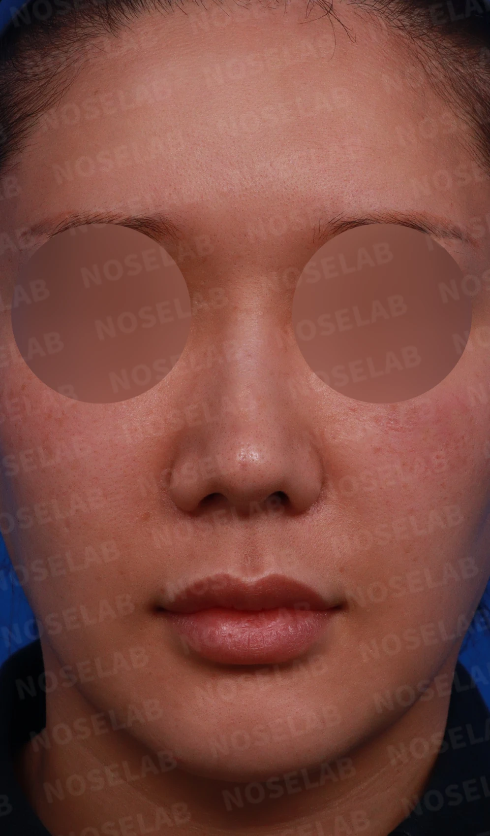 코 안의 이물질 제거와 재건을 계획하는 방법 — 디자인 상담 정면, 좌측 측면, 비스듬한 측면 사진