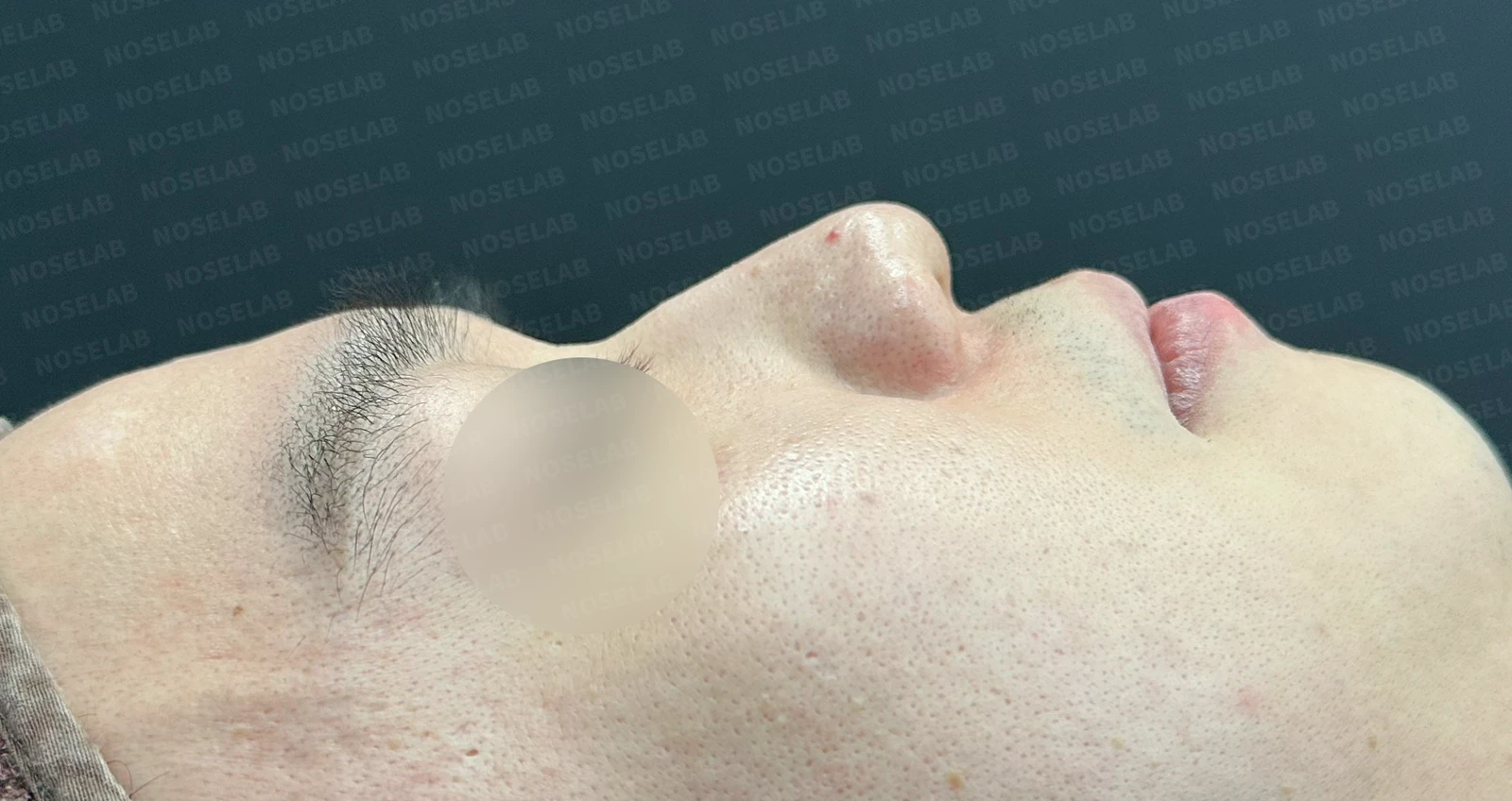 복코와 퍼진 코의 코성형 방법 — 수술 전 / 수술 직후 0일 직후 사진은 부기가 있는 상태로 최종 결과와 다를 수 있습니다.