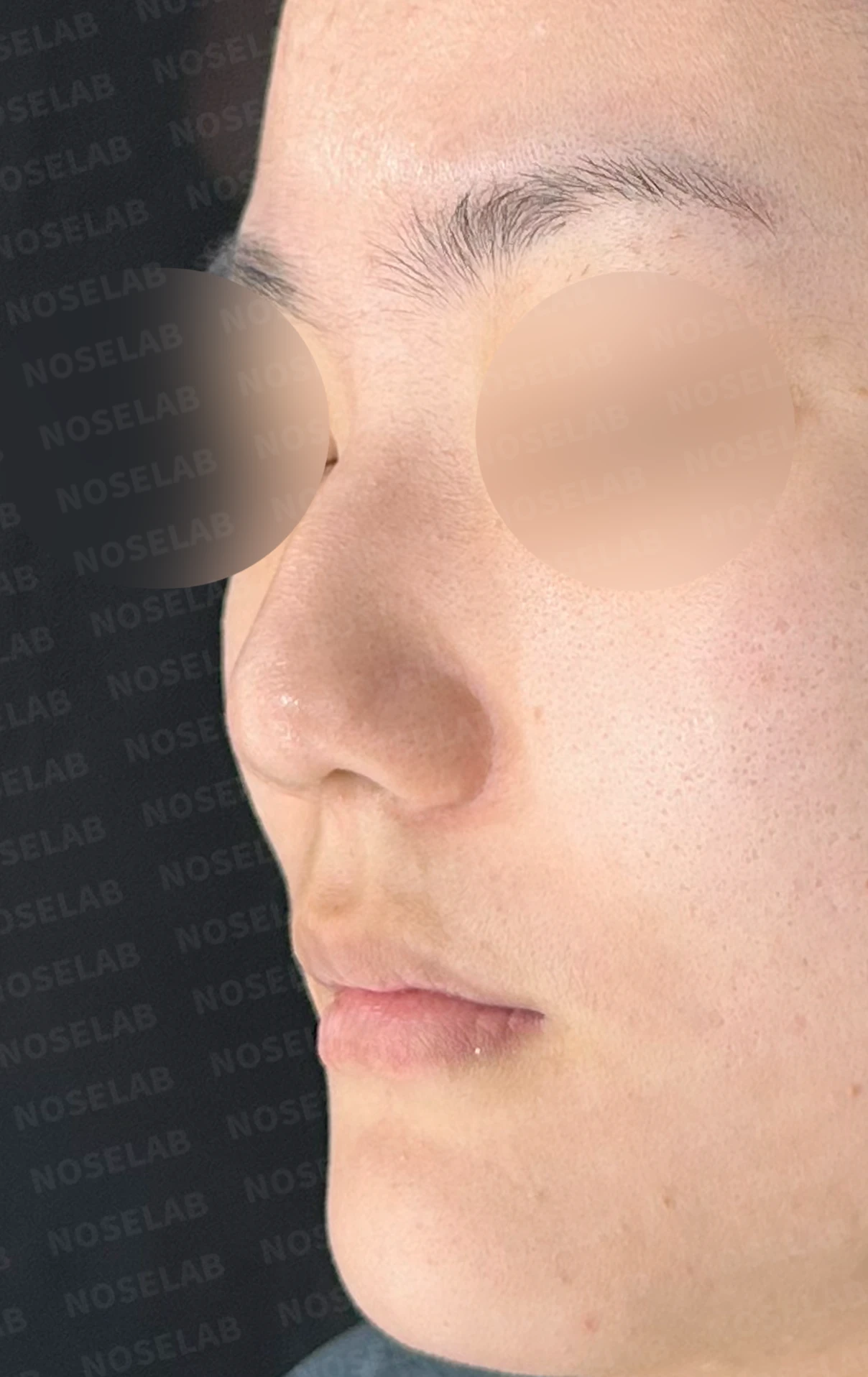 양악수술 뒤 코가 휘고 코끝이 뭉툭해지는 이유, 자가 늑연골로 매부리 라인을 만드는 방법 — 수술 전 / 수술 직후 0일 직후 사진은 부기가 있는 상태로 최종 결과와 다를 수 있습니다.