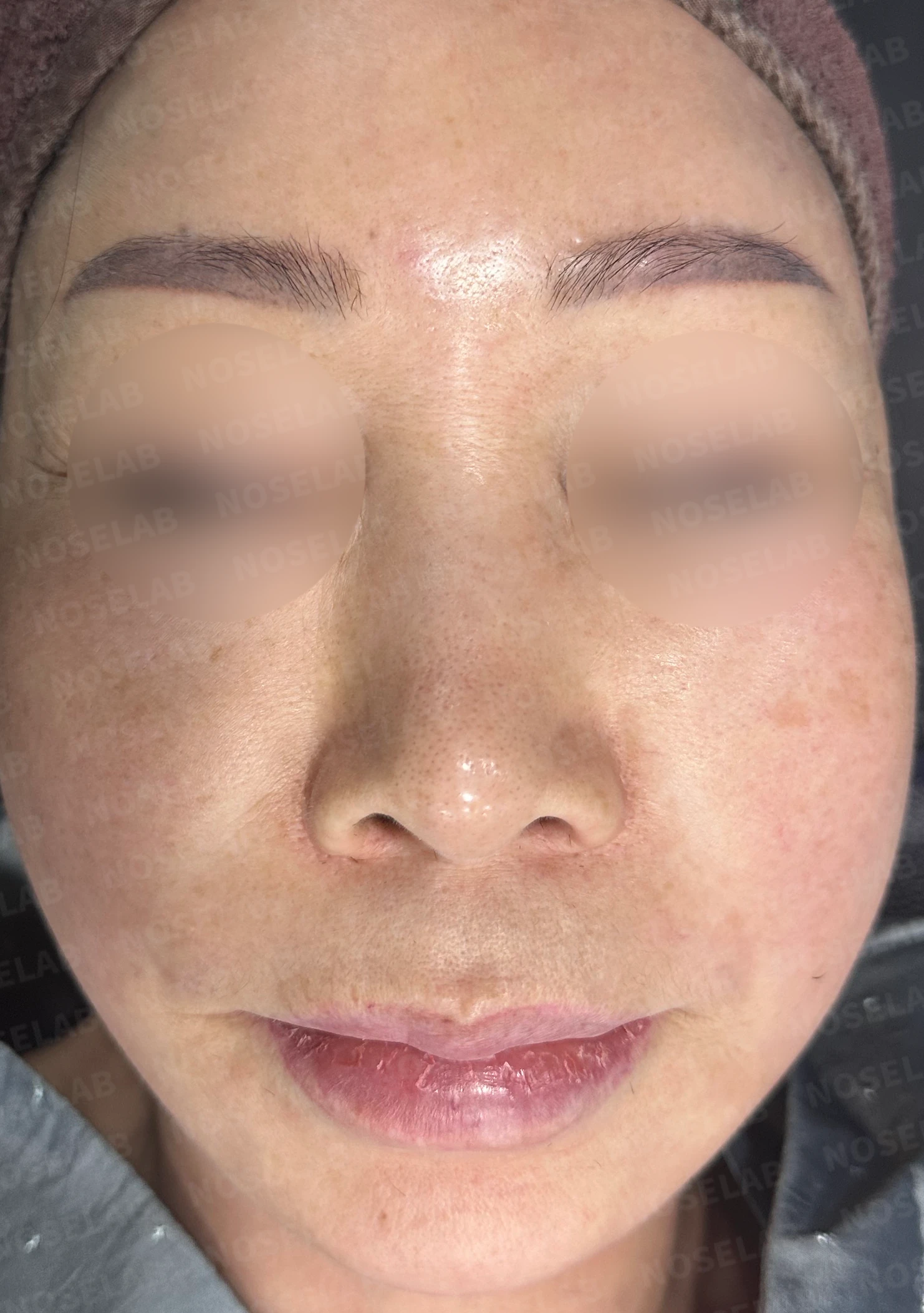 코 안에 남은 메드포어와 이물질, 왜 문제가 되고 어떻게 제거하나 — 수술 전 / 수술 직후 0일 직후 사진은 부기가 있는 상태로 최종 결과와 다를 수 있습니다.