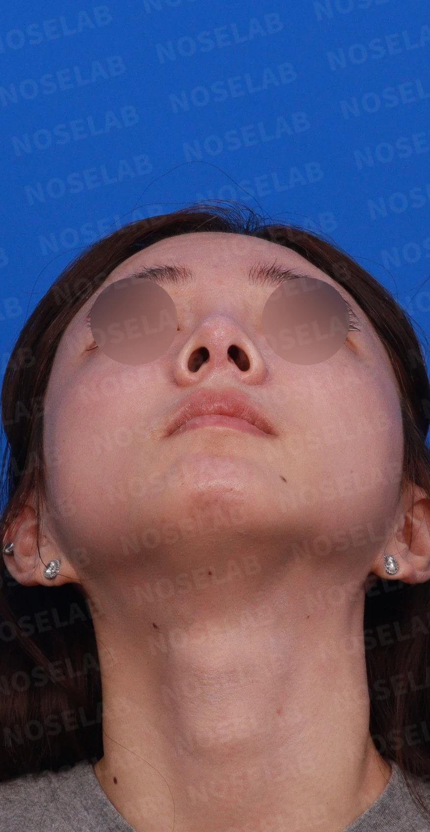 필러와 실 시술을 반복한 코에 미간이 퍼지고 코끝이 들리는 이유 — 디자인 상담 우측 비스듬한 측면 , 측면 , 비공 사진입니다.