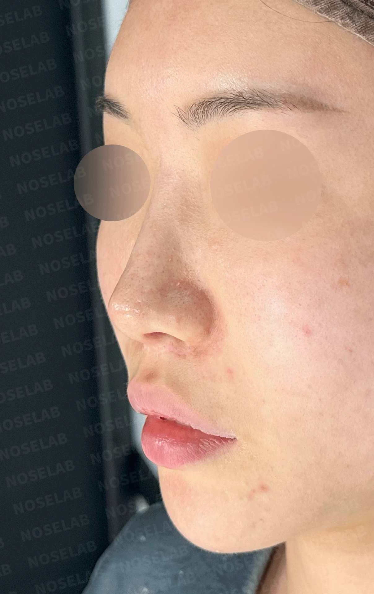 이전 수술로도 달라지지 않는 뭉툭한 코끝, 원인과 재건 방법 — 본문 사진 11