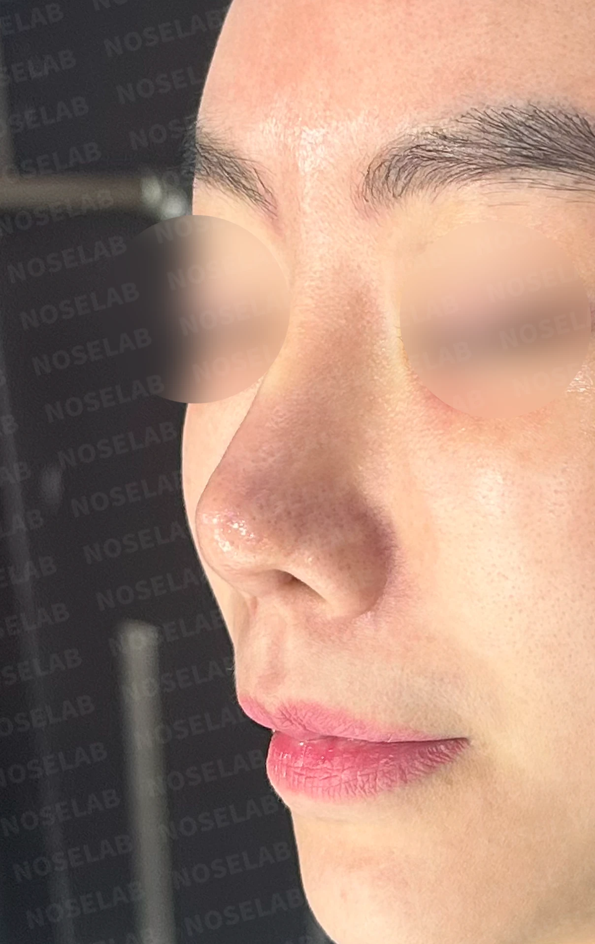이식한 진피가 반복해서 흡수되는 이유, 재건은 어떻게 하나 — 수술 전 / 수술 직후 0일 직후 사진은 부기가 있는 상태로 최종 결과와 다를 수 있습니다.
