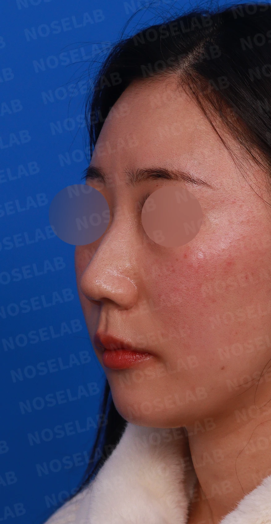 코뼈 비대칭과 처진 코끝에 만성 비염이 겹칠 때 보는 것 — 디자인 상담 정면, 좌측 측면, 비스듬한 측면 사진