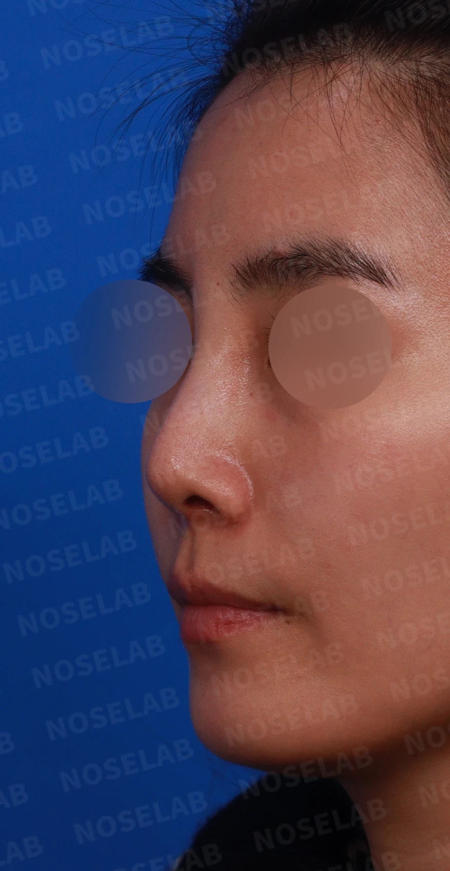 여러 차례 받은 코필러가 남긴 퍼진 코와 코막힘, 어떻게 정리하나 — 디자인 상담 정면, 좌측 측면, 비스듬한 측면 사진