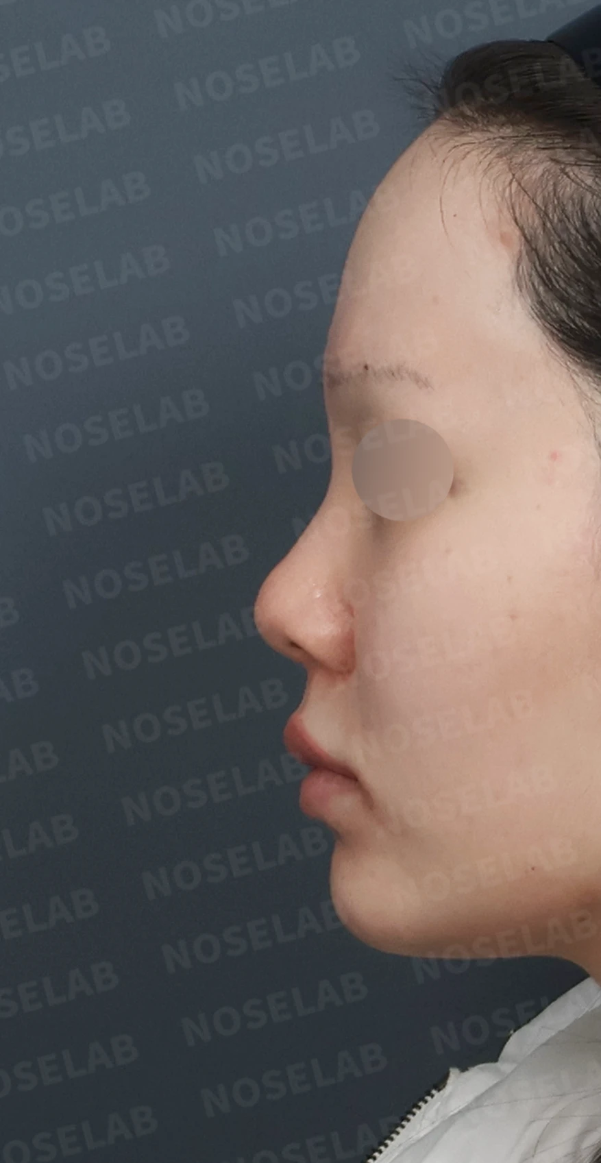 복코와 들린 코끝, 자가늑연골로 여성스러운 직반라인 완성 — 디자인 상담 정면, 좌측 측면, 비스듬한 측면 사진입니다.
