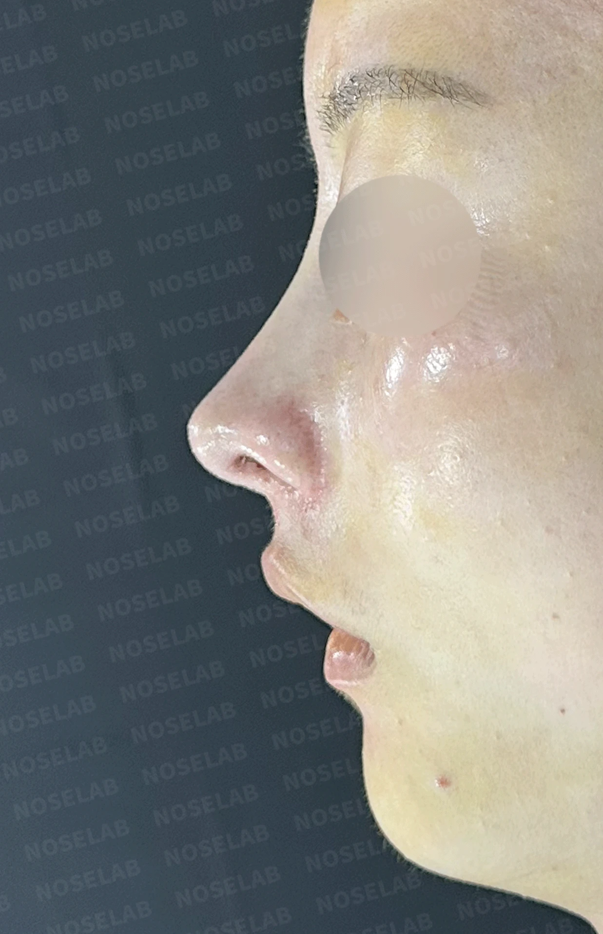 콧대가 인위적으로 보이고 코가 들리는 이유, 재건은 어떻게 하나 — 본문 사진 10