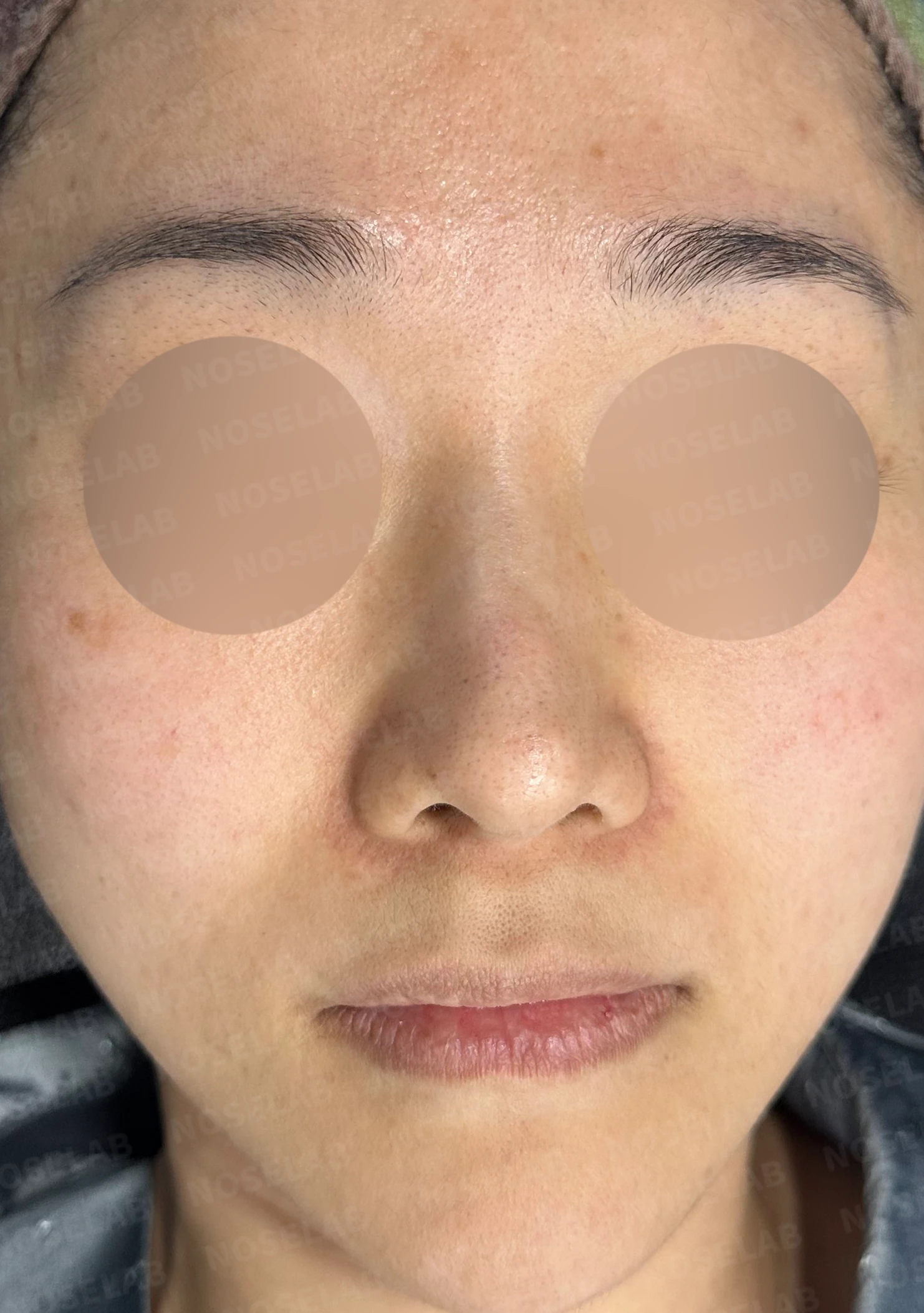 비중격 연골이 약해진 코, 보형물 없이 재건하는 방법 — 수술 전 / 수술 직후 0일 직후 사진은 부기가 있는 상태로 최종 결과와 다를 수 있습니다.
