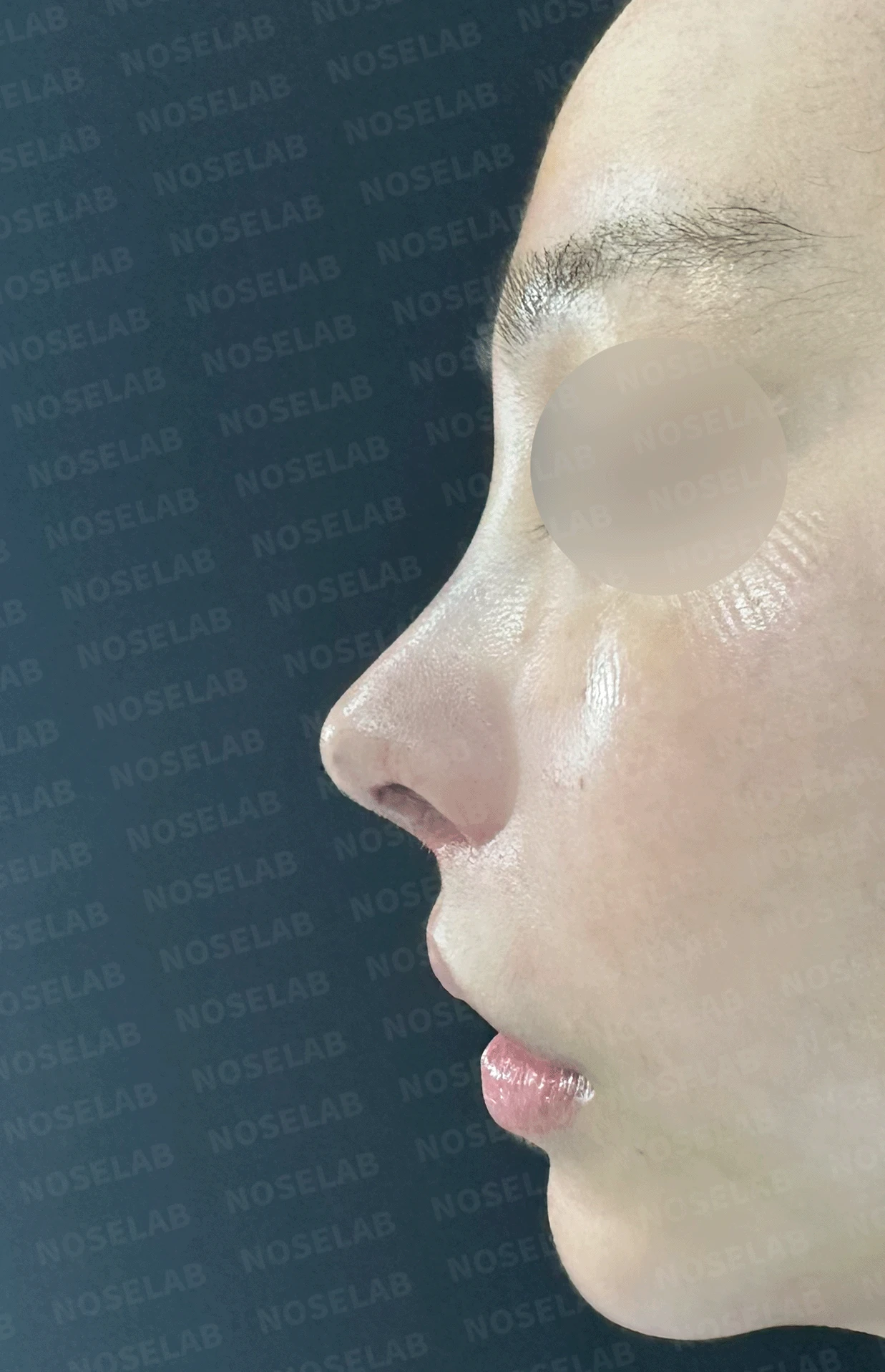 여러 번 수술해도 콧대가 낮고 복코가 남는 이유, 늑연골 재건과 얼굴 균형 — 본문 사진 10