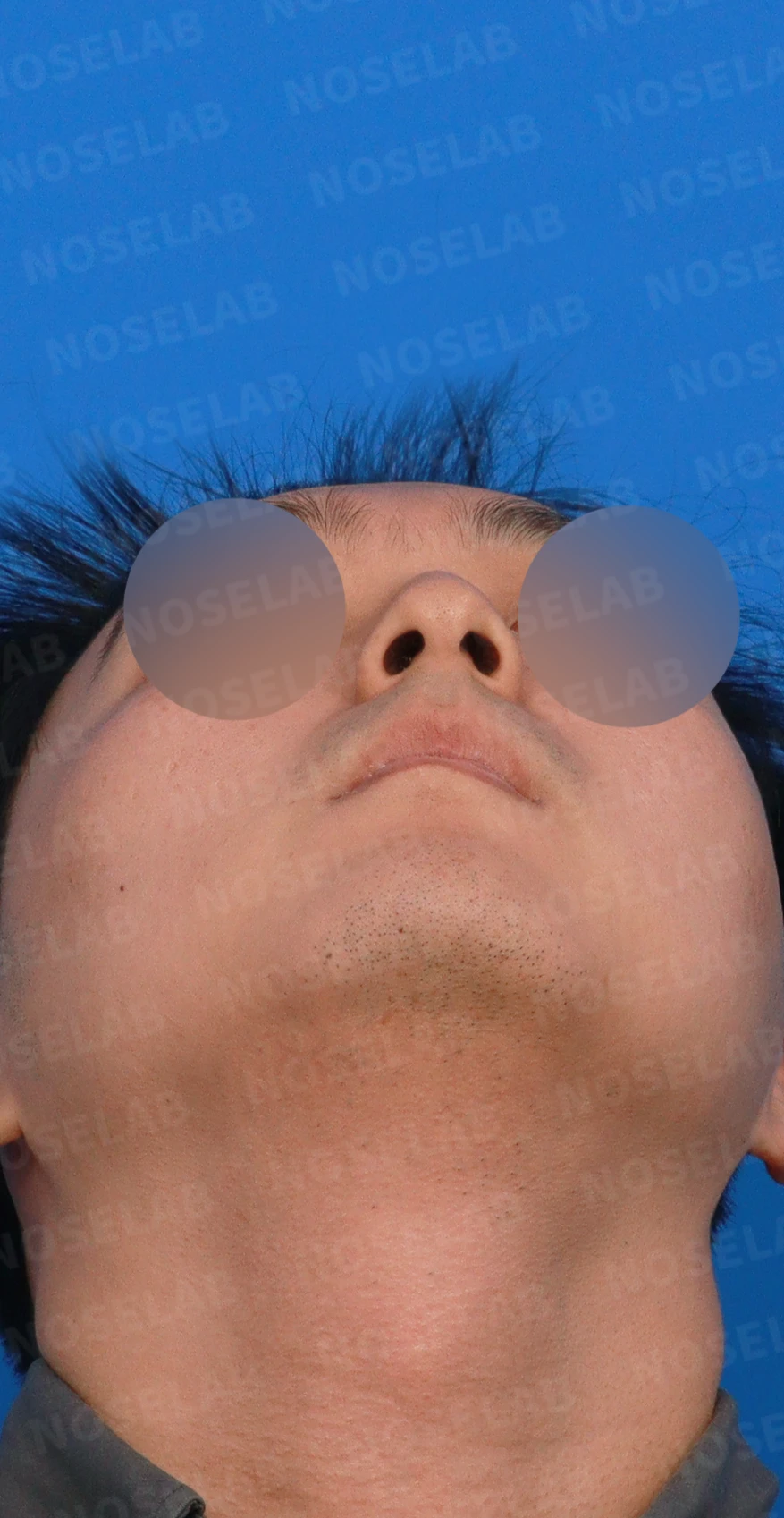 비중격이 휘면 코막힘과 휜 코가 함께 생기는 이유, 재건은 어떻게 하나 — 디자인 상담 우측 측면, 비스듬한 측면, 비공 사진입니다.