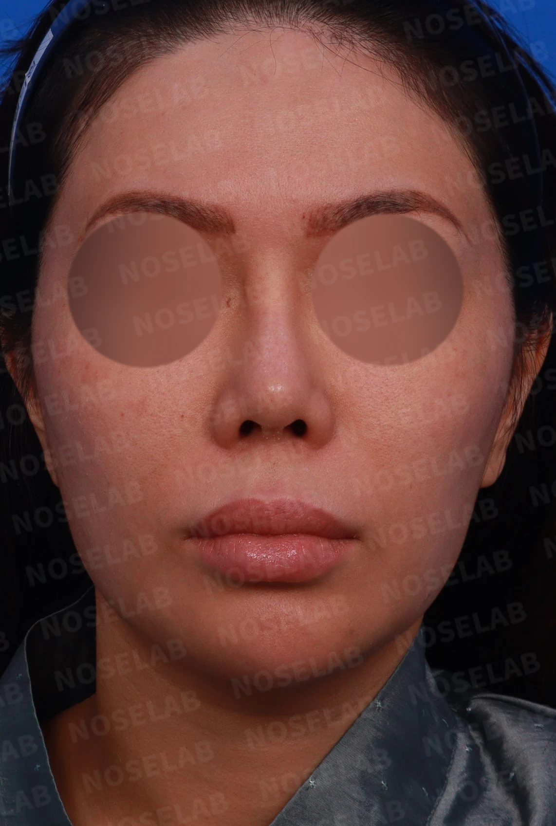실리텍스 보형물이 비쳐 보이는 이유와 제거 후 재건은 어떻게 하나 — 디자인 상담 정면, 좌측 측면, 비스듬한 측면 사진