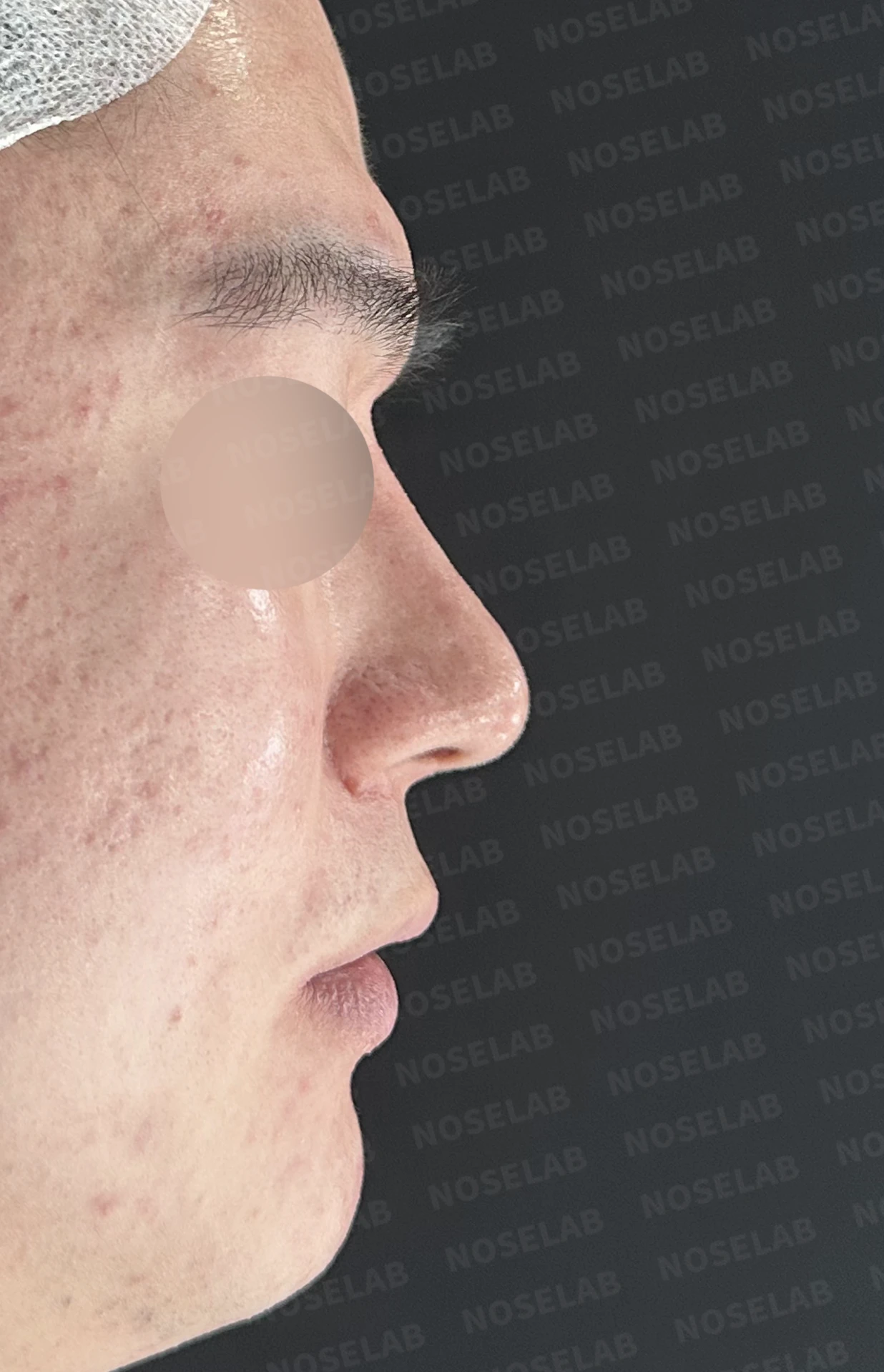 콧대를 더 높이고 싶을 때 무엇이 한계를 만드나, 3D 맞춤 보형물과 자가늑연골 코끝 지지 — 수술 전 / 수술 직후 0일 직후 사진은 부기가 있는 상태로 최종 결과와 다를 수 있습니다.