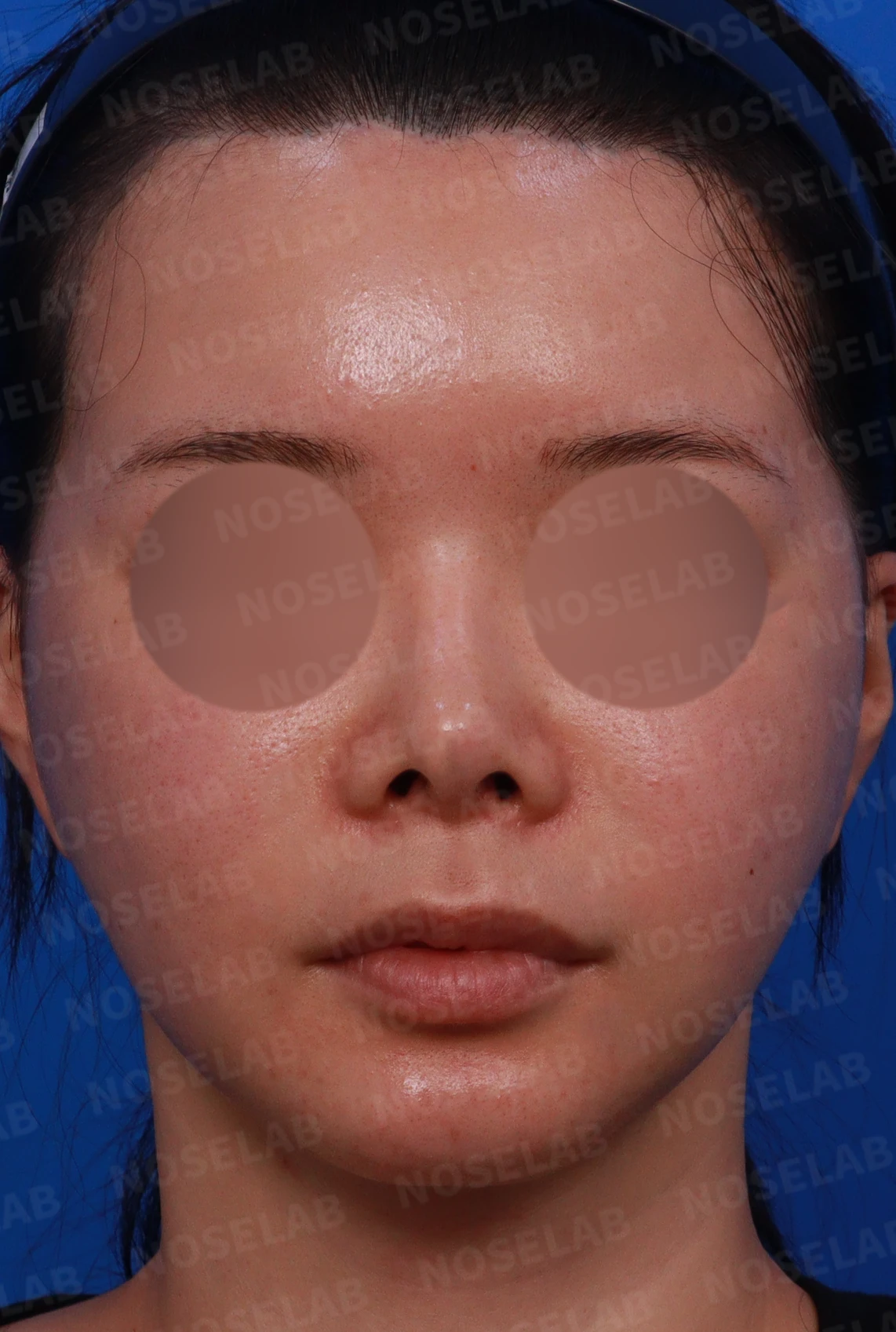 코끝 피부 상태와 괴사 위험을 고려한 재수술 계획 — 수술전 디자인 상담 정면, 측면, 비스듬한 측면 [들린코, 퍼진코, 휜코]