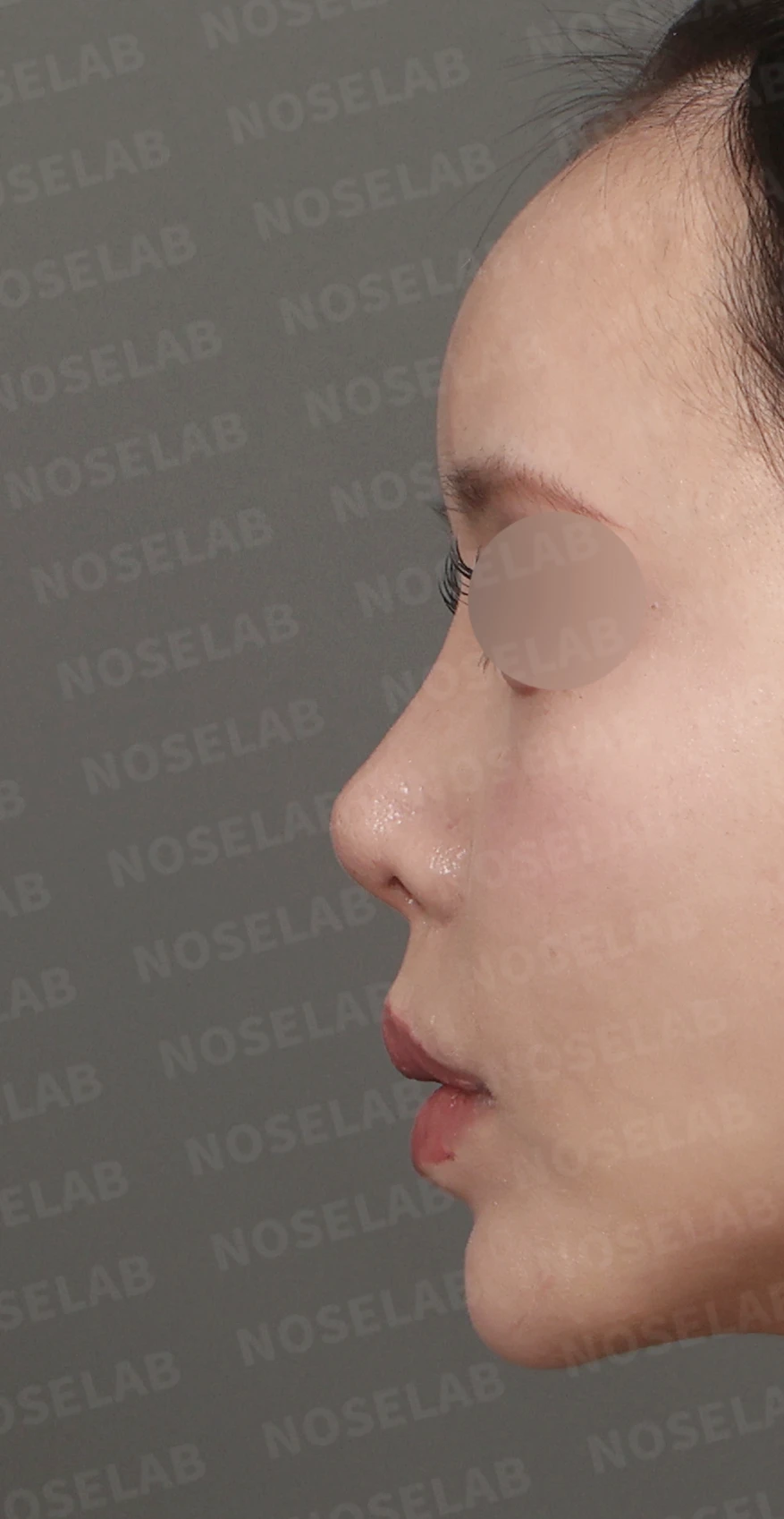 들리고 찌그러진 코끝, 자가늑연골로 비중격 재건한 코성형 사례 — 디자인 상담 정면, 좌측 측면, 비스듬한 측면 사진