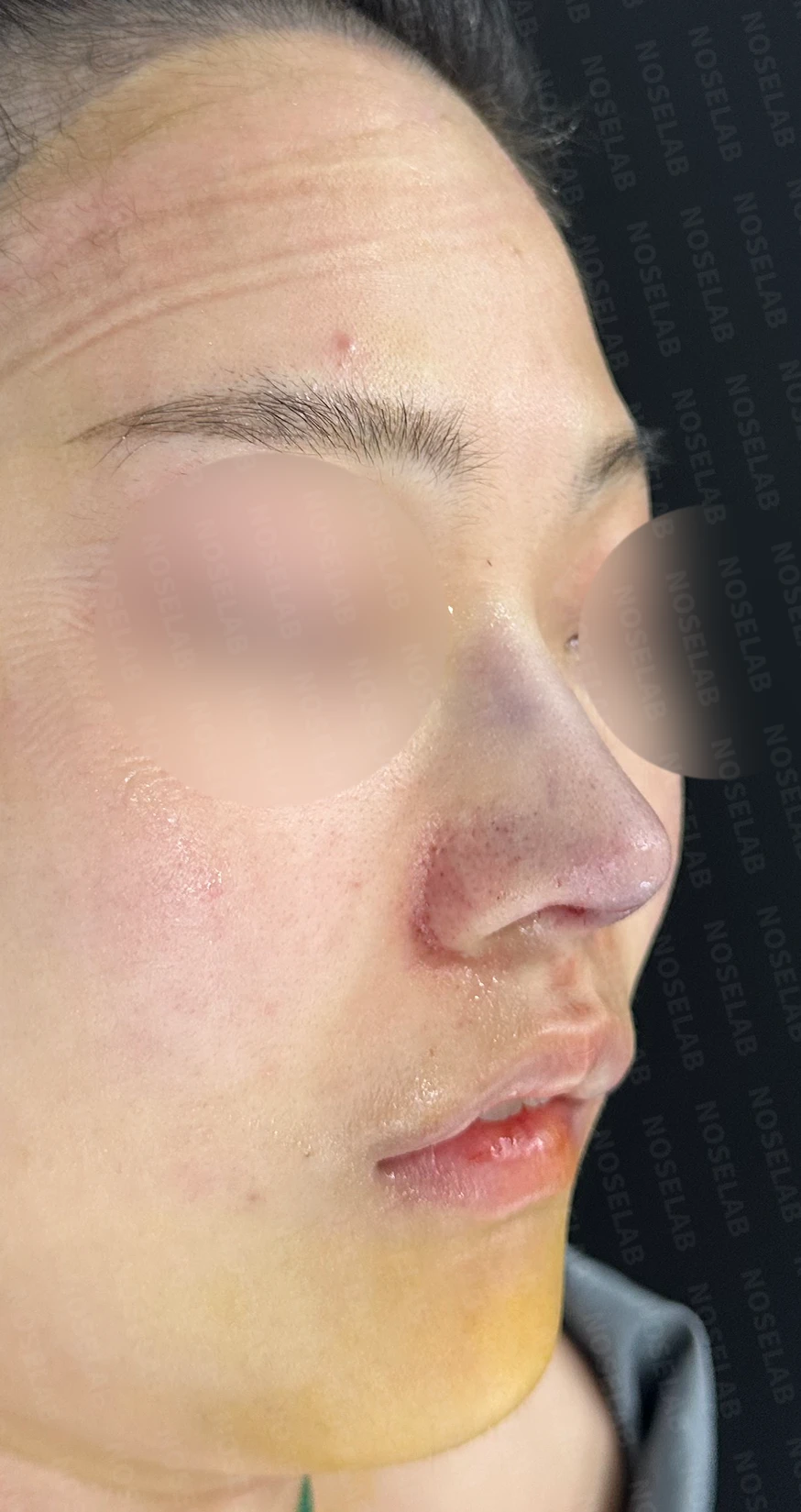 찝혀 올라간 콧구멍 교정 방법 — 수술 직후 0일 사진 정면, 비스듬한 측면, 측면 직후 사진은 부기가 있는 상태로 최종 결과와 다를 수 있습니다.