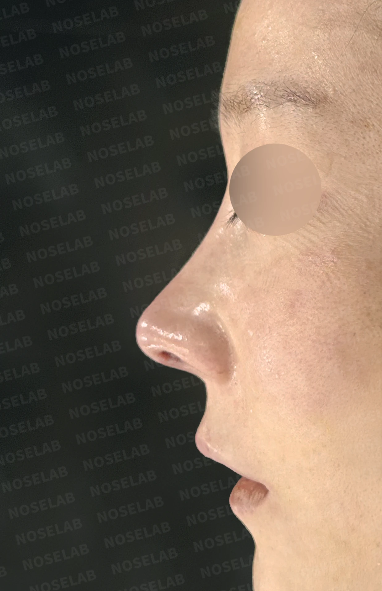 코끝 피부 함몰과 보형물 비침, 자가늑연골로 안전하게 복원한 코재수술 — 전(좌) 직후(우)
