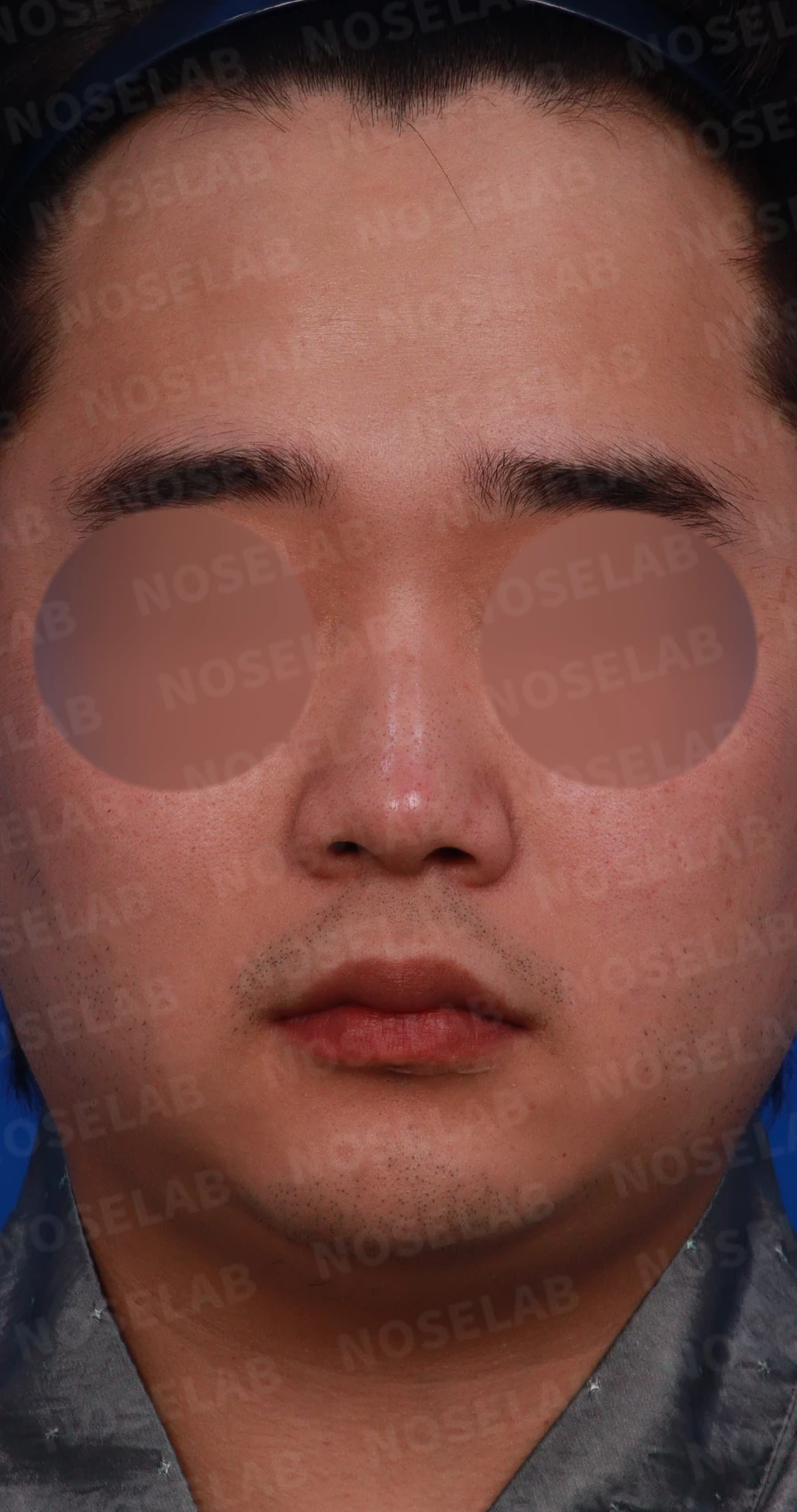 작은 코의 비율과 높이를 고려한 코성형 방법 — 수술전 디자인 상담 정면, 우측 측면, 비스듬한 측면 사진입니다.