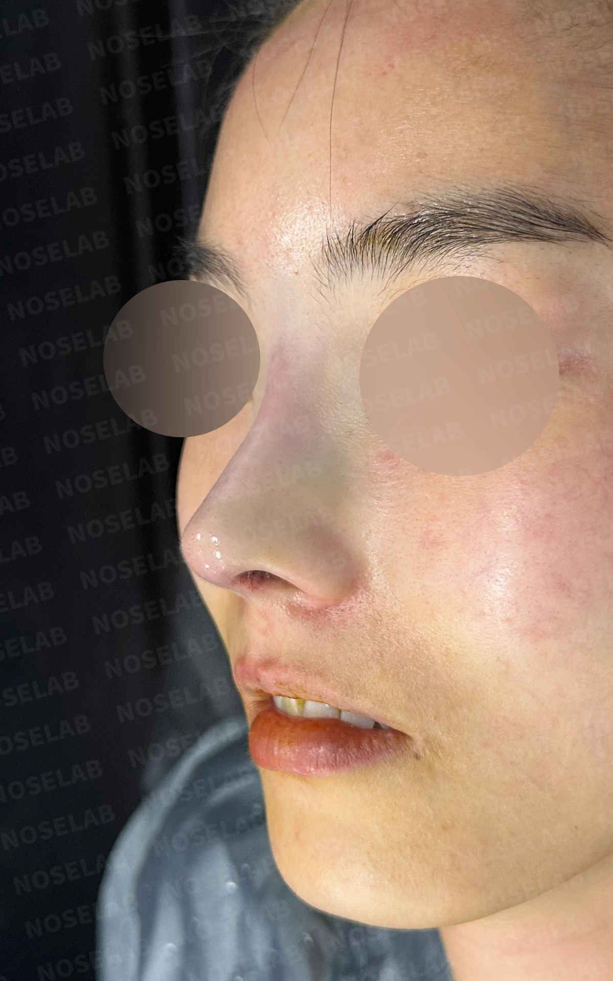 여러 차례 받은 코필러가 남긴 퍼진 코와 코막힘, 어떻게 정리하나 — 수술 직후 0일 정면, 측면, 비스듬한 측면 사진 직후 사진은 부기가 있는 상태로 최종 결과와 다를 수 있습니다.