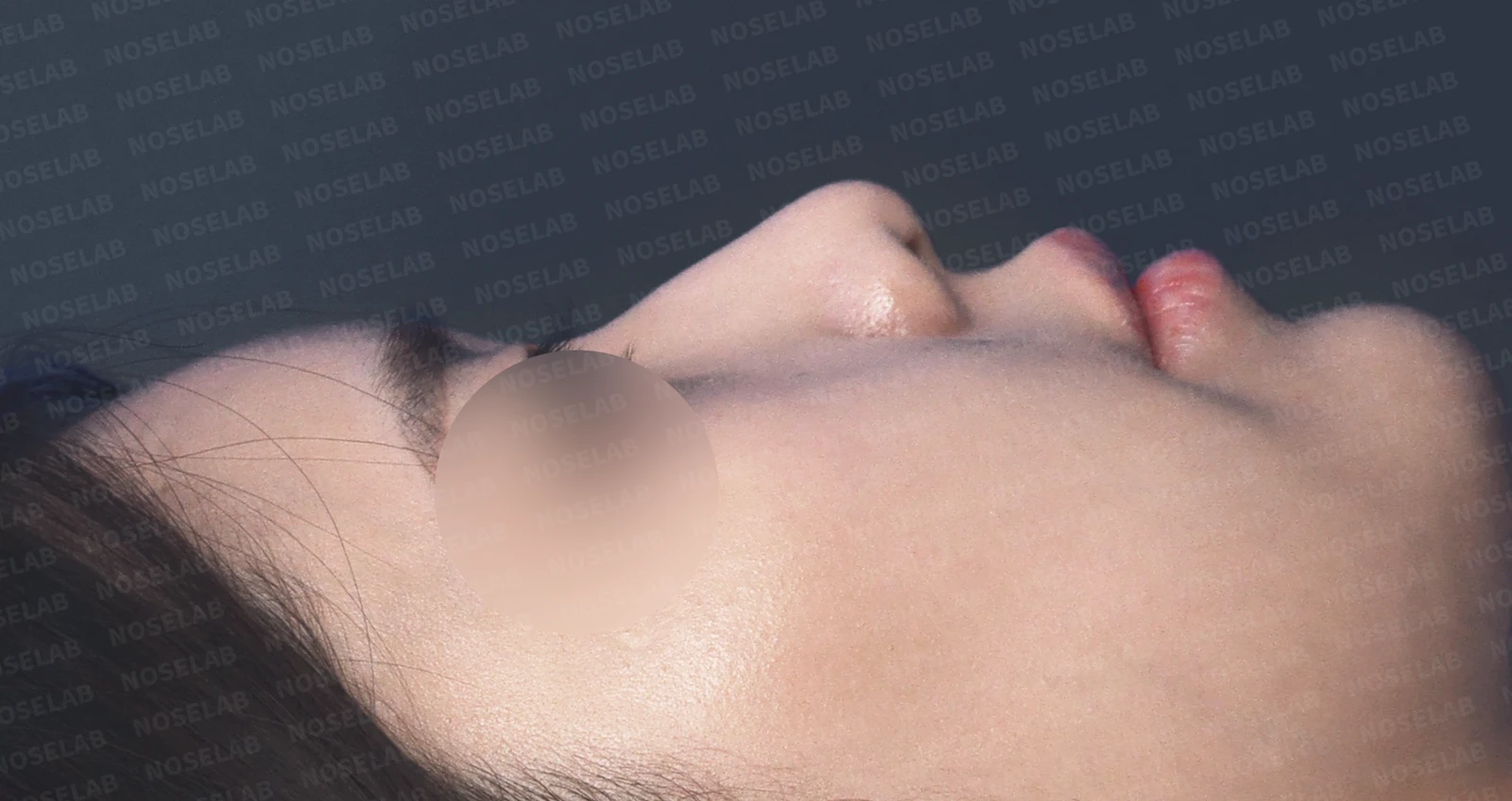돌출입과 비순각을 함께 살펴보는 코성형 계획 — 수술 전 / 수술 직후 0일 직후 사진은 부기가 있는 상태로 최종 결과와 다를 수 있습니다.