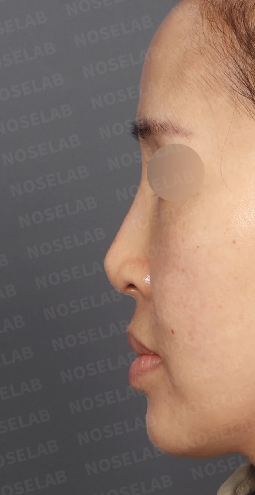 보형물 비침과 용코, 자가늑연골로 안전하게 교정한 코재수술 — 디자인 상담 정면, 좌측 측면, 비스듬한 측면 사진입니다.