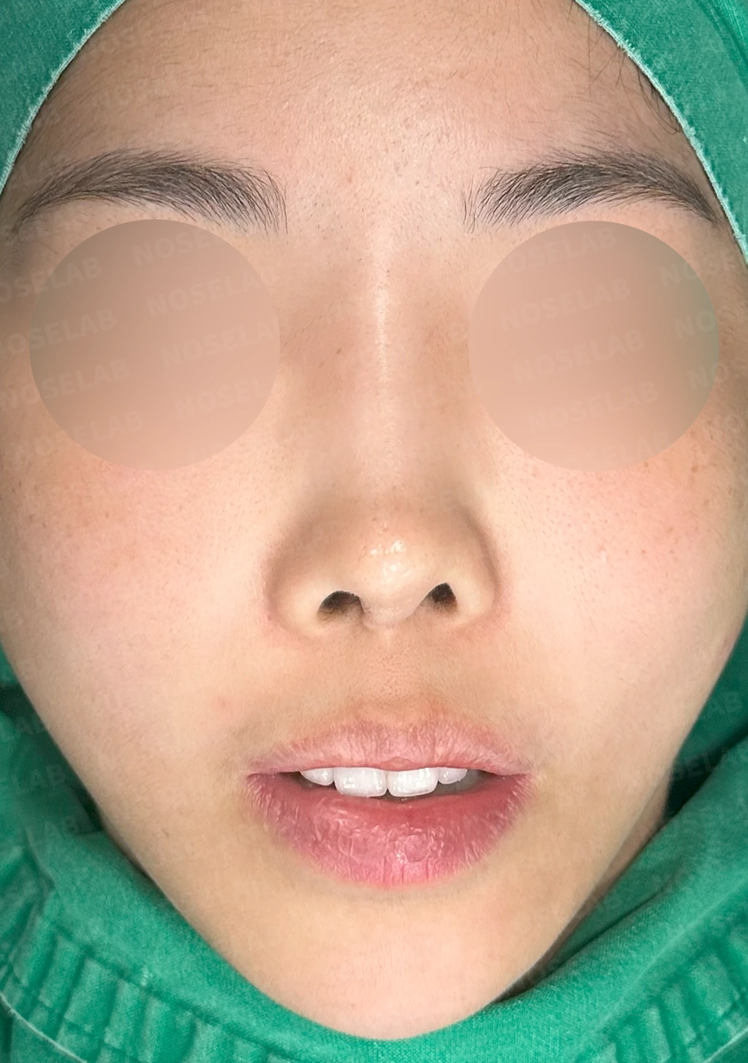 보형물을 넣고 빼기를 반복한 코에 남는 콧등 패임과 들린 느낌 — 수술 전 / 수술 직후 0일 직후 사진은 부기가 있는 상태로 최종 결과와 다를 수 있습니다.