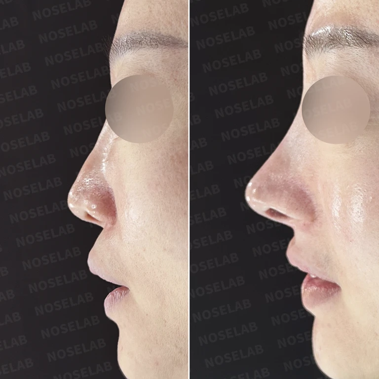 휘어진 코와 무너진 비중격, 자가늑연골로 자연스럽게 교정하다 — 전후 비교