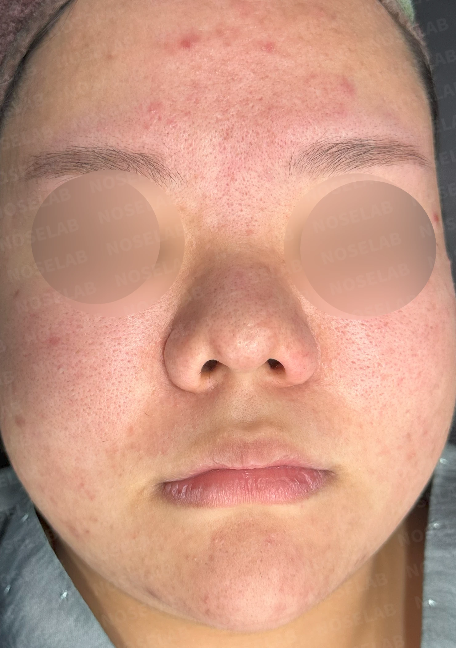 복코와 짧은 코, 비주 함몰이 함께 나타나는 이유와 코끝 입체감을 만드는 방법 — 수술 전 / 수술 직후 0일 직후 사진은 부기가 있는 상태로 최종 결과와 다를 수 있습니다.