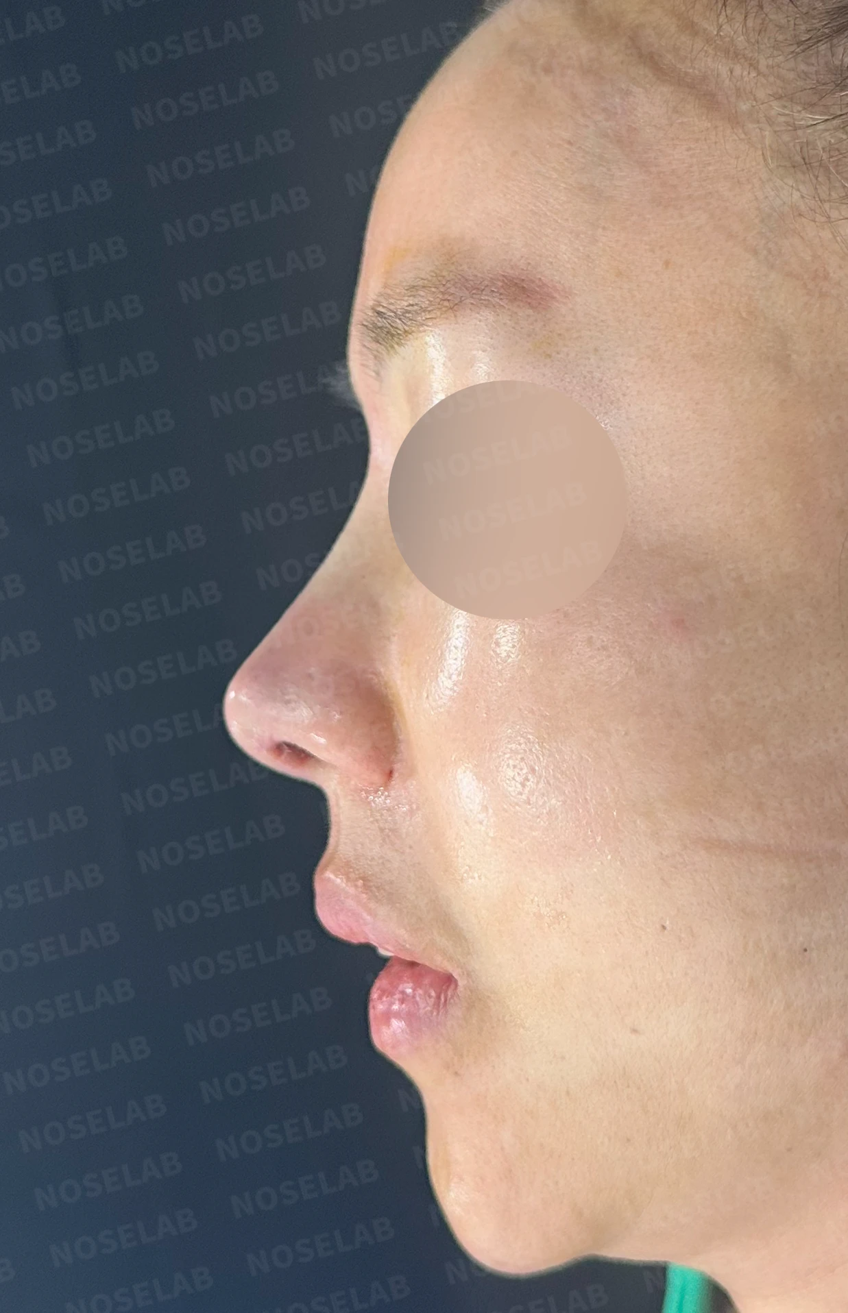 보형물을 제거한 뒤 콧대가 꺼지고 퍼지는 이유, 재건은 어떻게 하나 — 수술 전 / 수술 직후 0일 직후 사진은 부기가 있는 상태로 최종 결과와 다를 수 있습니다.