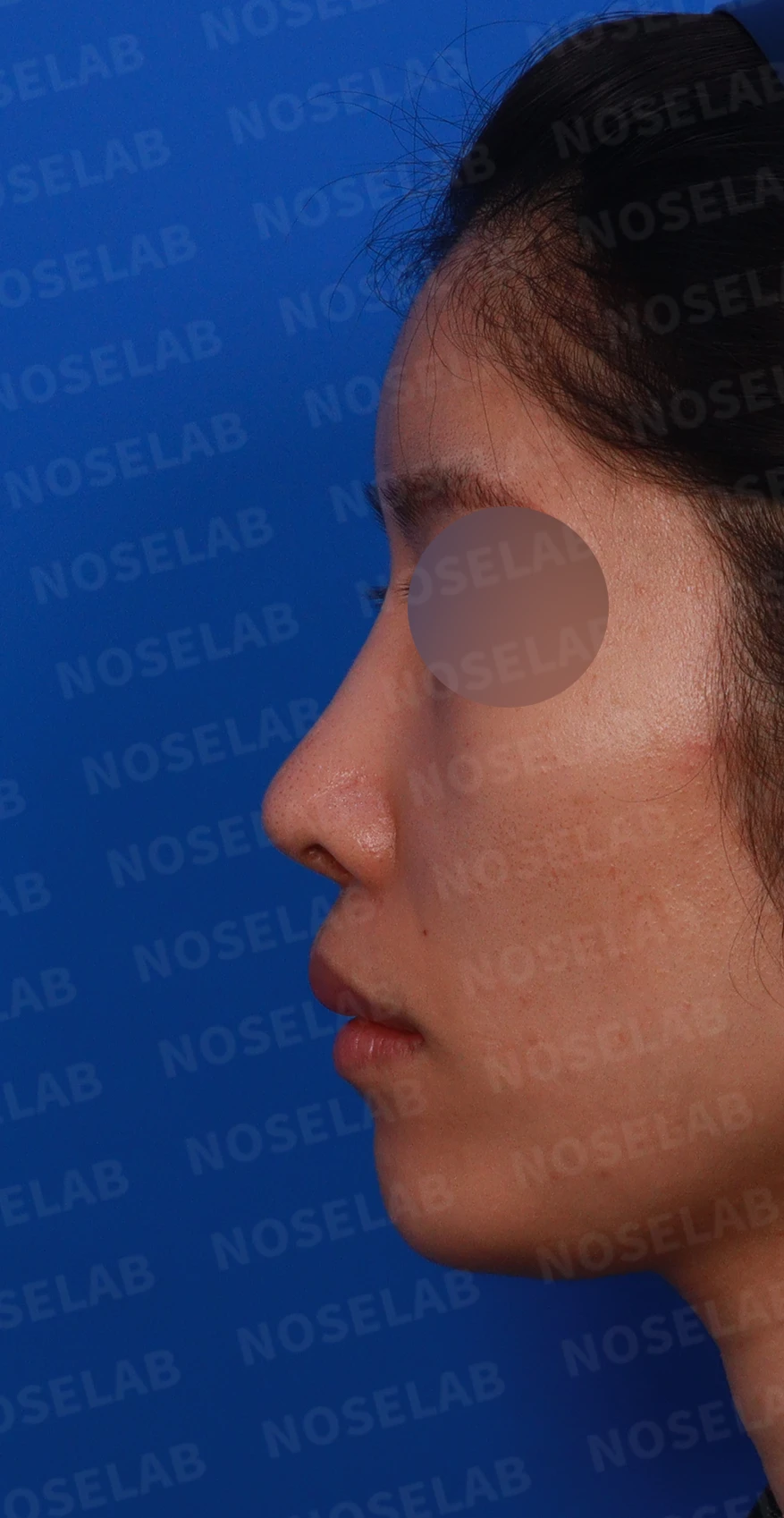 코 수술 뒤 염증이 오래 지속되면 생기는 변화와 재건 방법 — 디자인 상담 정면, 비스듬한 측면, 좌측 측면 사진입니다.