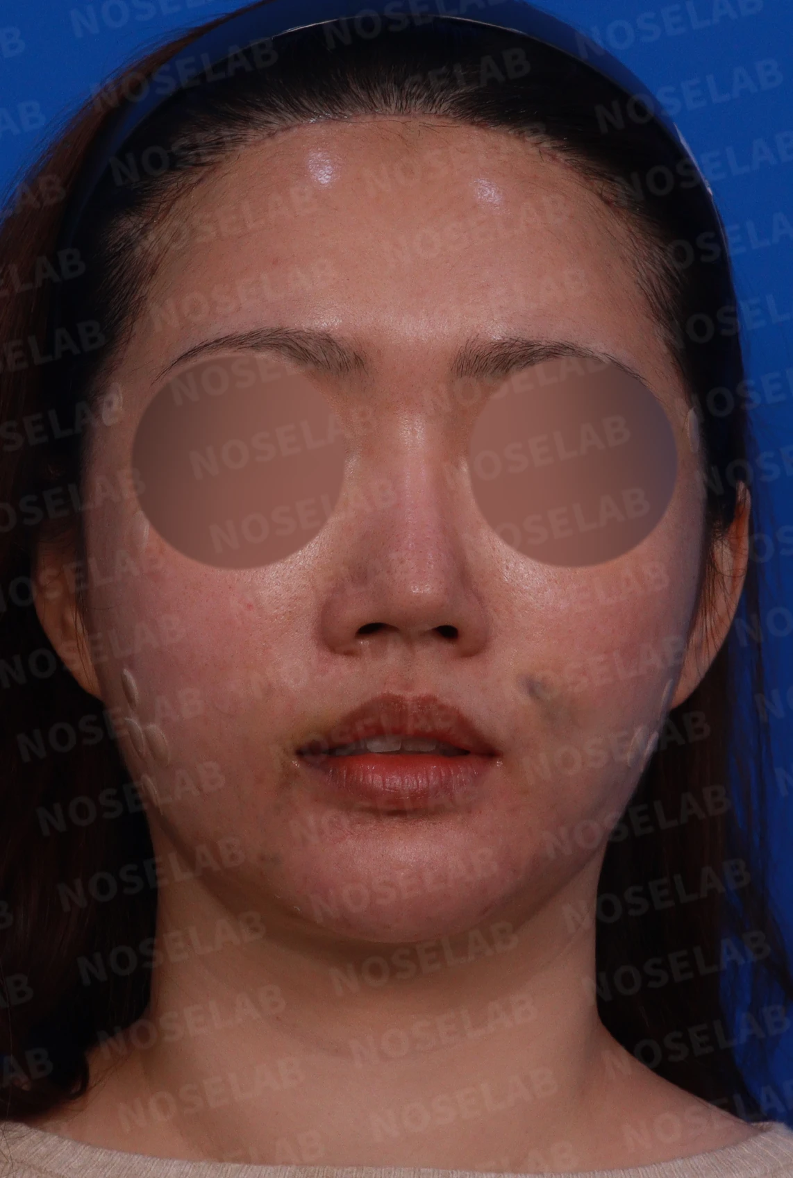 재수술한 코가 휘어 보이고 코끝이 처지는 이유 — 디자인 상담 정면, 좌측 측면, 비스듬한 측면 사진