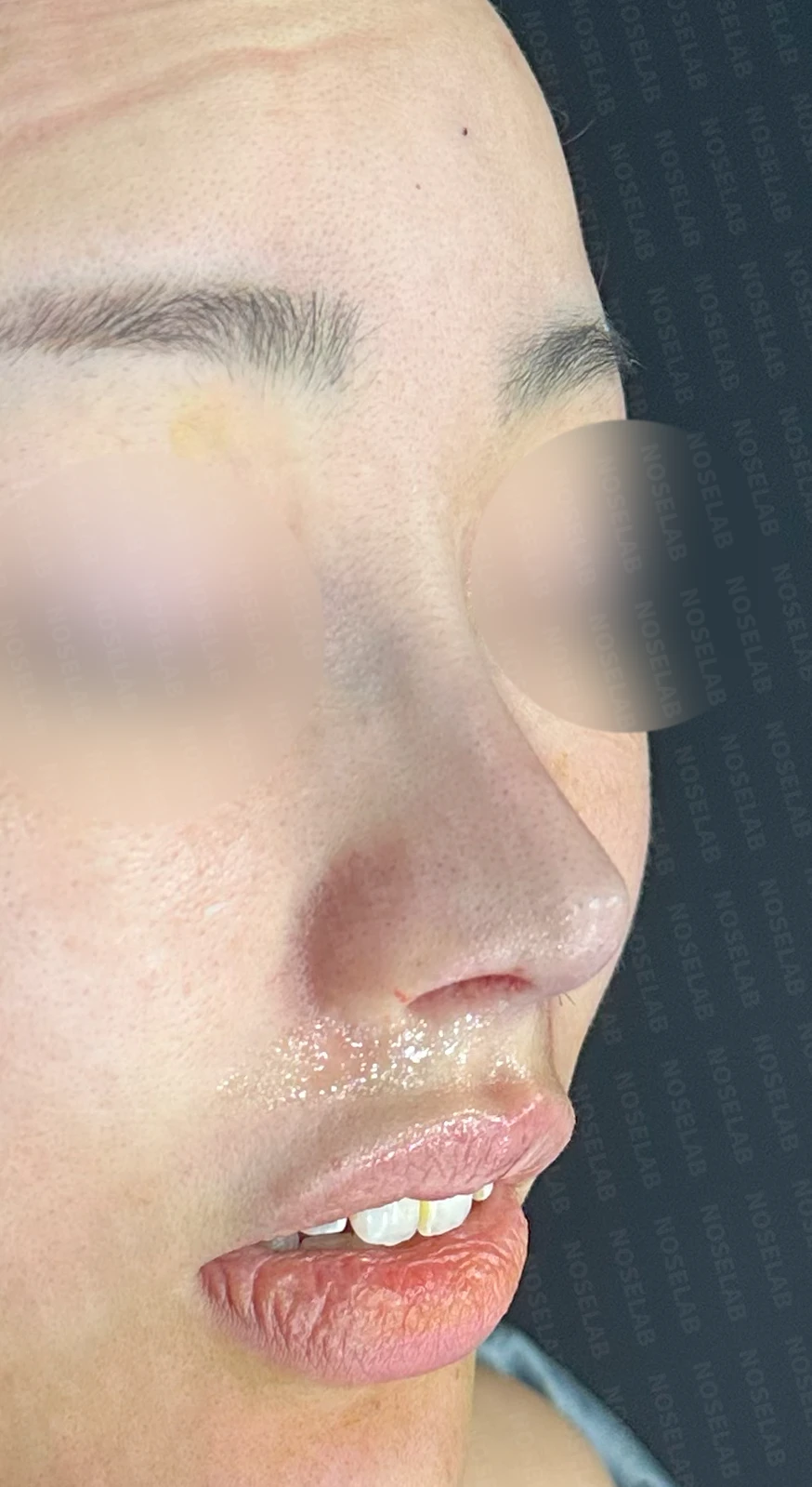 비공협착과 휜코, 코막힘을 함께 살펴보는 재수술 방법 — 수술 직후 0일 정면, 측면, 비스듬한 측면 직후 사진은 부기가 있는 상태로 최종 결과와 다를 수 있습니다.
