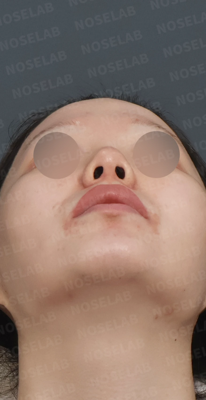 복코와 들린 코끝, 자가늑연골로 여성스러운 직반라인 완성 — 디자인 상담 우측 측면, 비스듬한 측면, 비공 사진입니다.