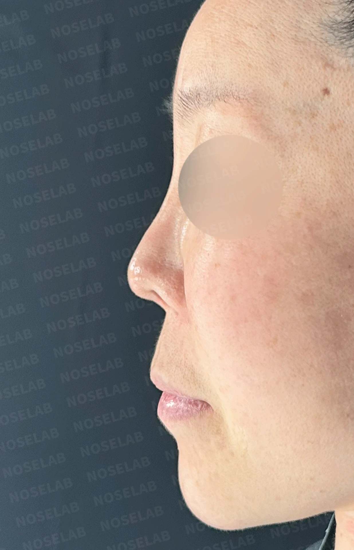 코가 짧고 들리며 비주가 함몰되는 이유, 자가 늑연골 재건은 어떻게 하나 — 본문 사진 10