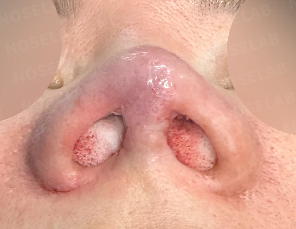 코끝이 찝히고 비주가 함몰되는 이유, 메드포어 제거와 재건은 어떻게 하나 — 수술 직후 0일 비공 사진 직후 사진은 부기가 있는 상태로 최종 결과와 다를 수 있습니다.